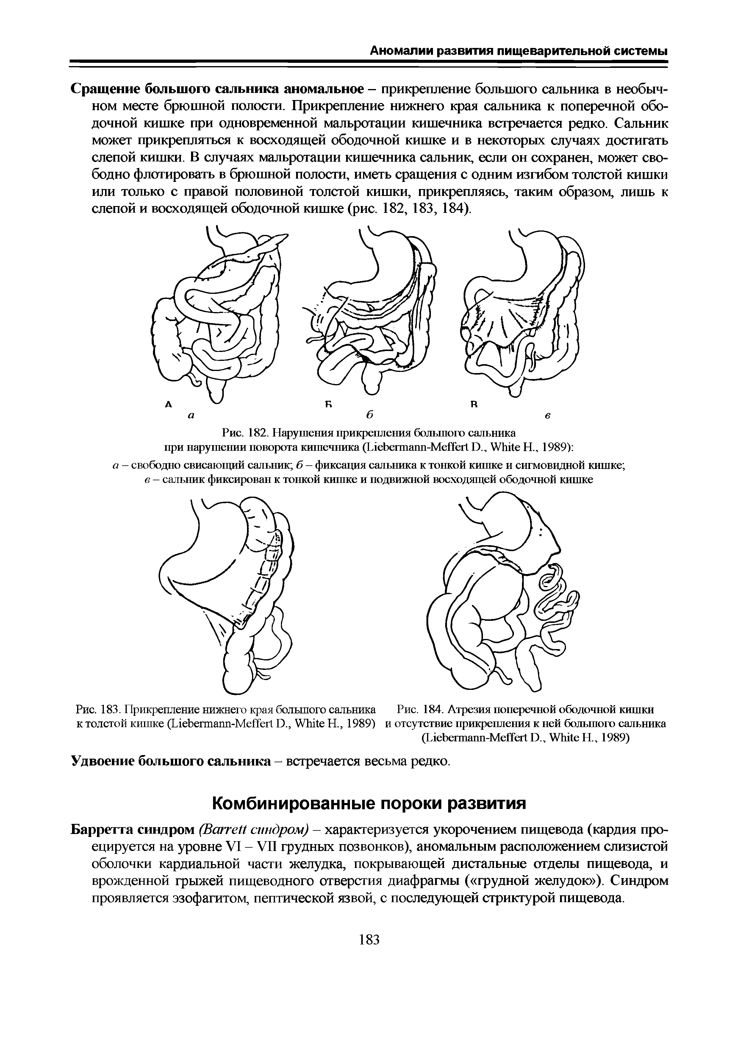 Рис. 182. Нарушения прикрепления большого сальника при нарушении поворота кишечника (L -M D., W Н., 1989) ...