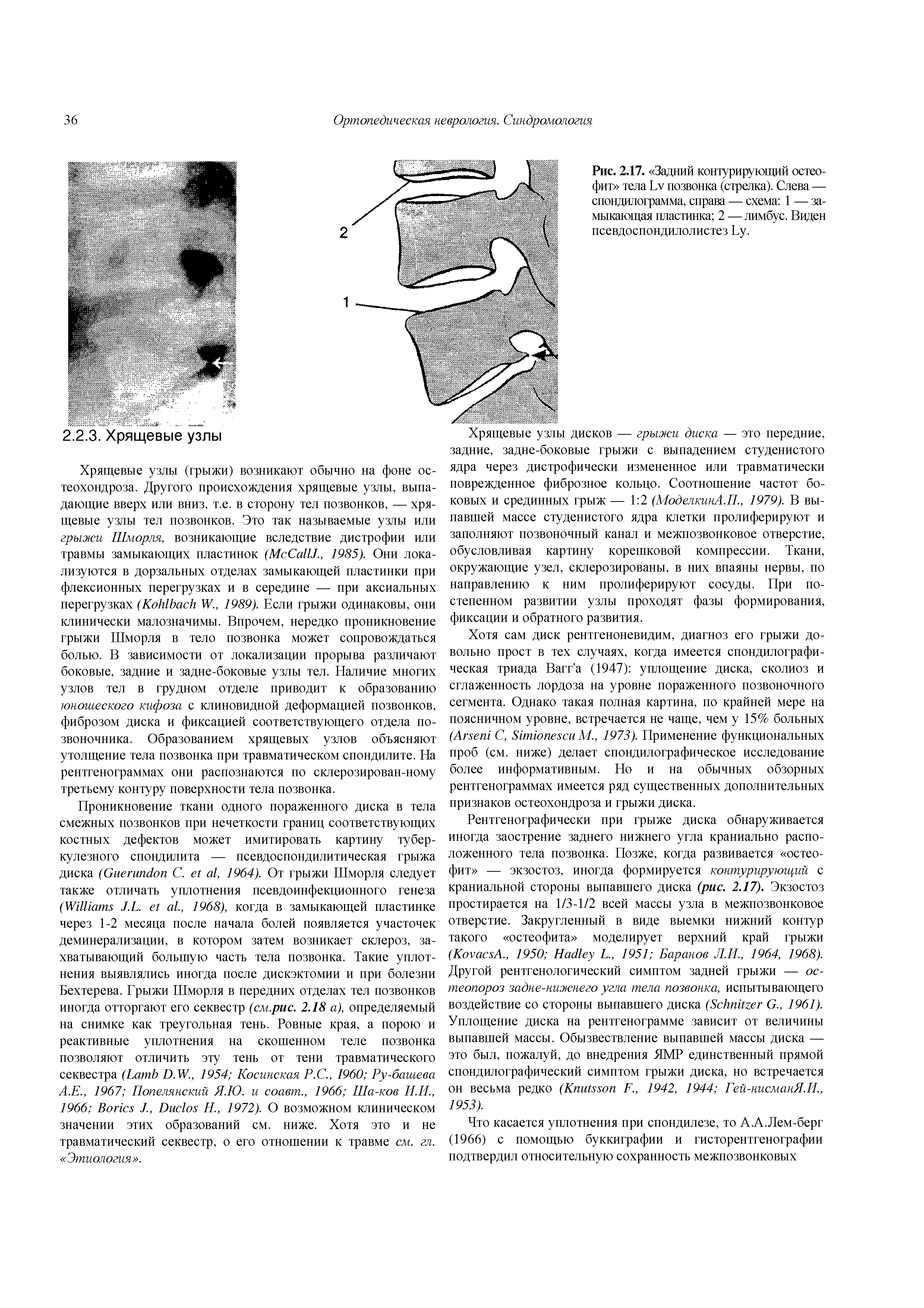 Рис. 2.17. Задний контурирующий остеофит тела I, у позвонка (стрелка). Слева — спондилограмма, справа — схема 1 — замыкающая пластинка 2 — лимбус. Виден псевдоспондилолистез Бу.