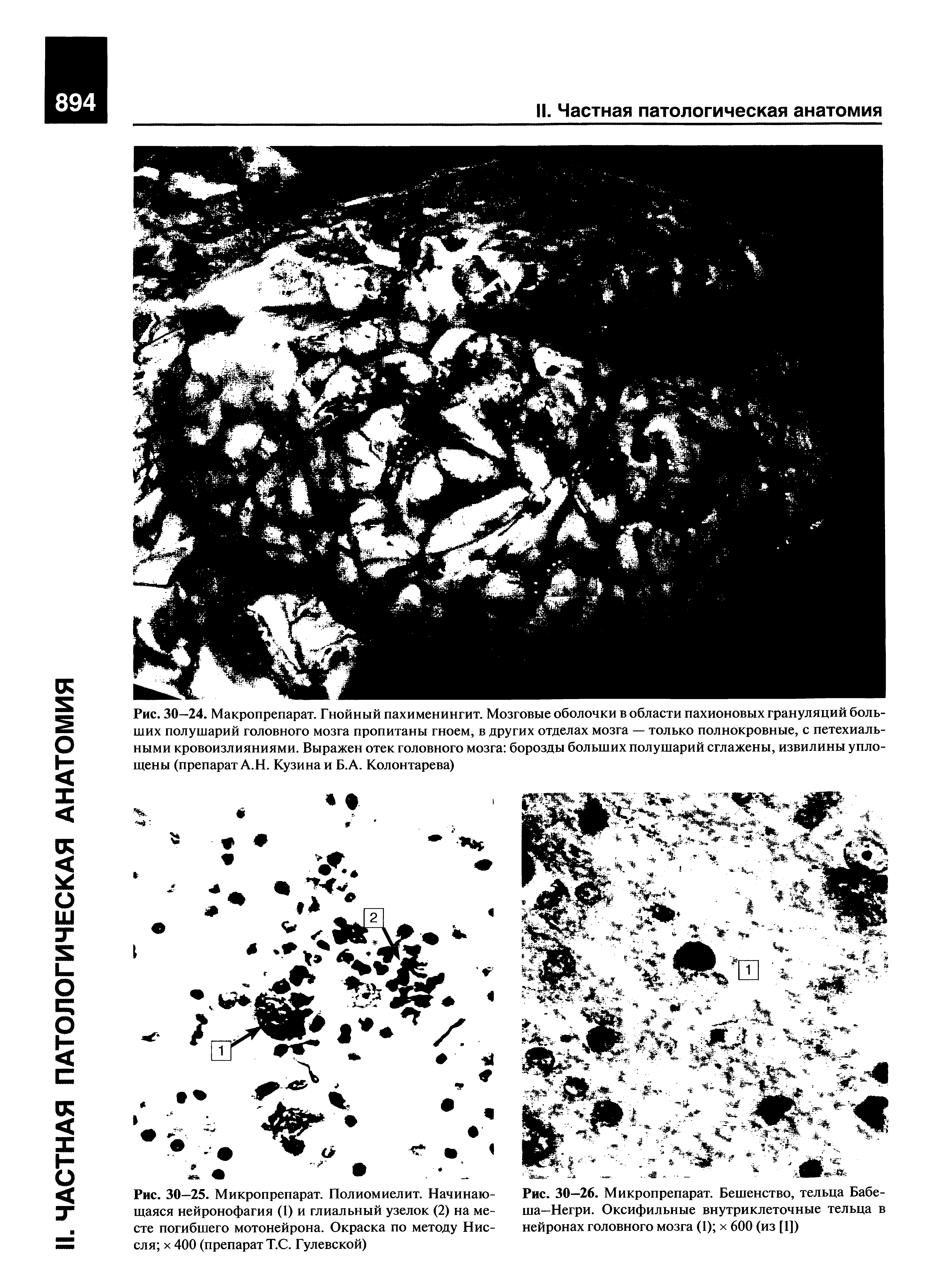 Рис. 30—26. Микропрепарат. Бешенство, тельца Бабе-ша—Негри. Оксифильные внутриклеточные тельца в нейронах головного мозга (1) х 600 (из [1])...