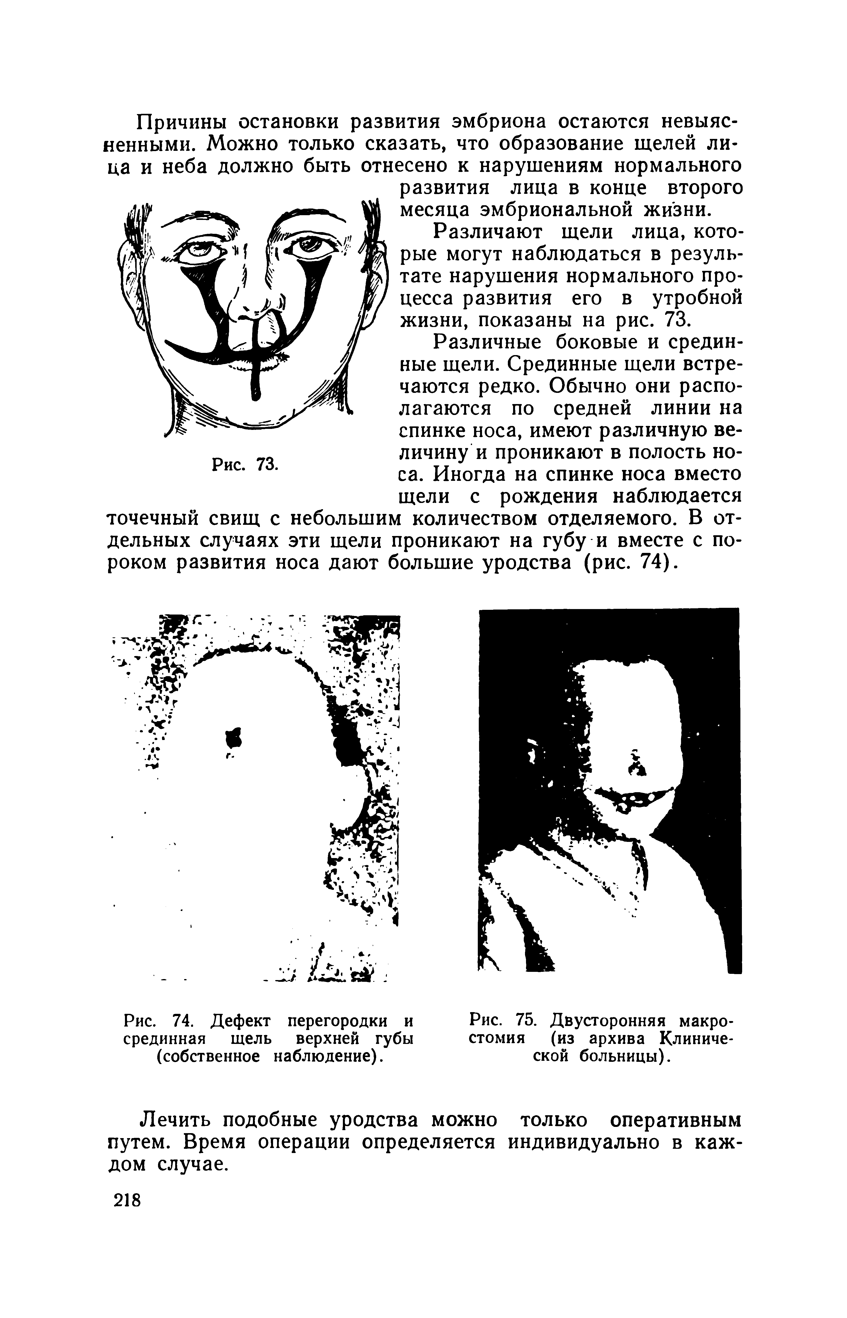 Рис. 74. Дефект перегородки и срединная щель верхней губы (собственное наблюдение).