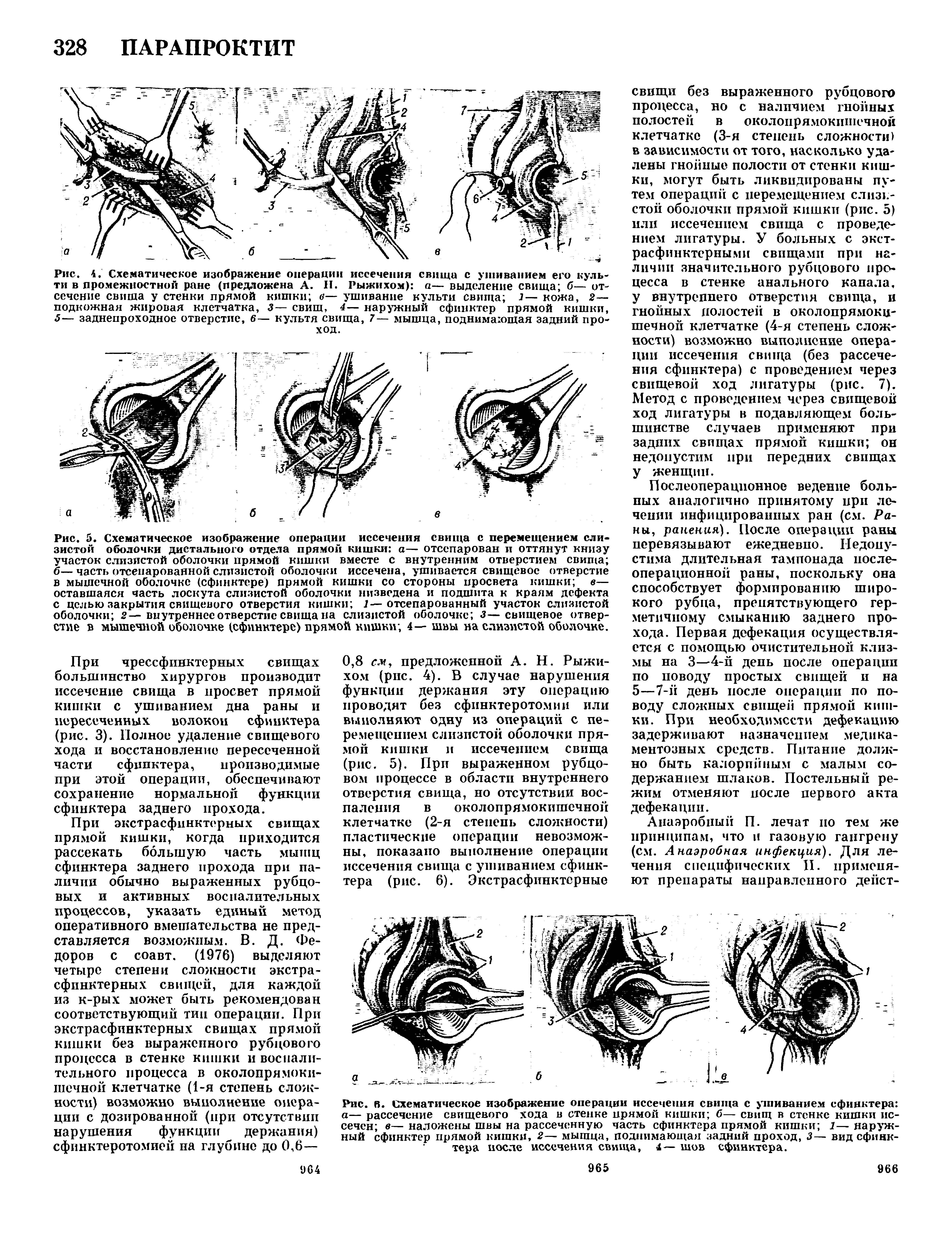 Лечение свища