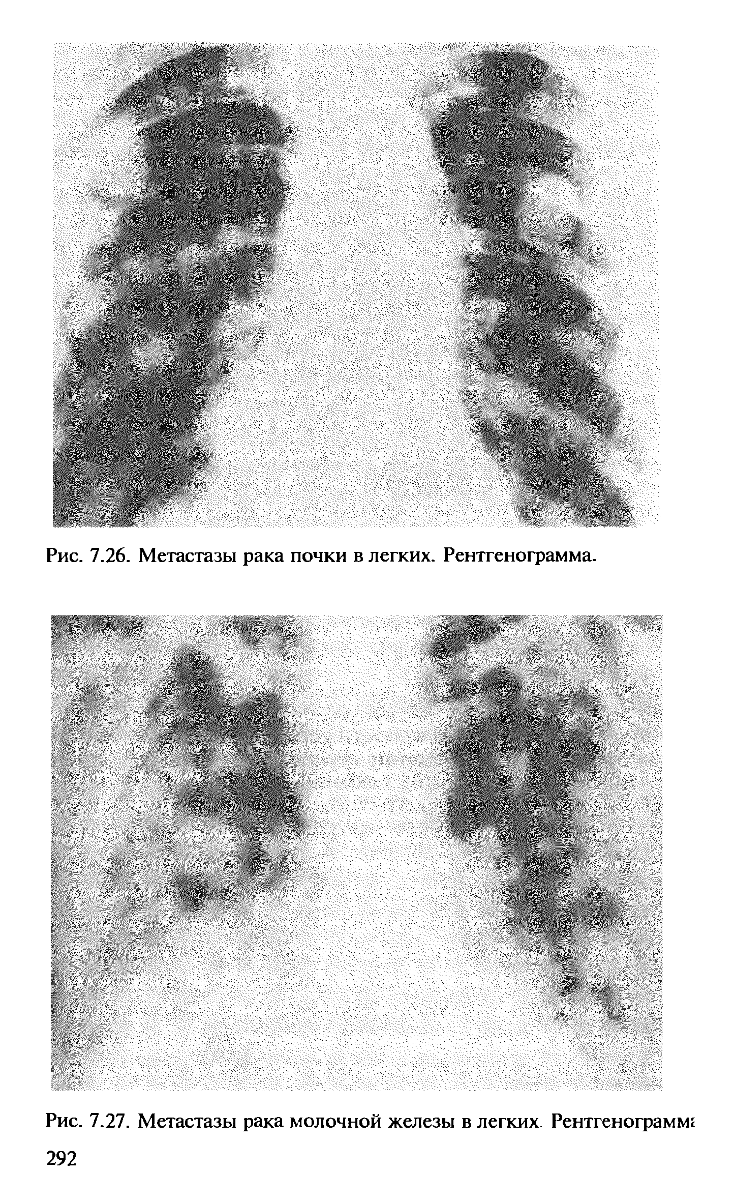 Рис. 7.27. Метастазы рака молочной железы в легких. Рентгенограмм ...