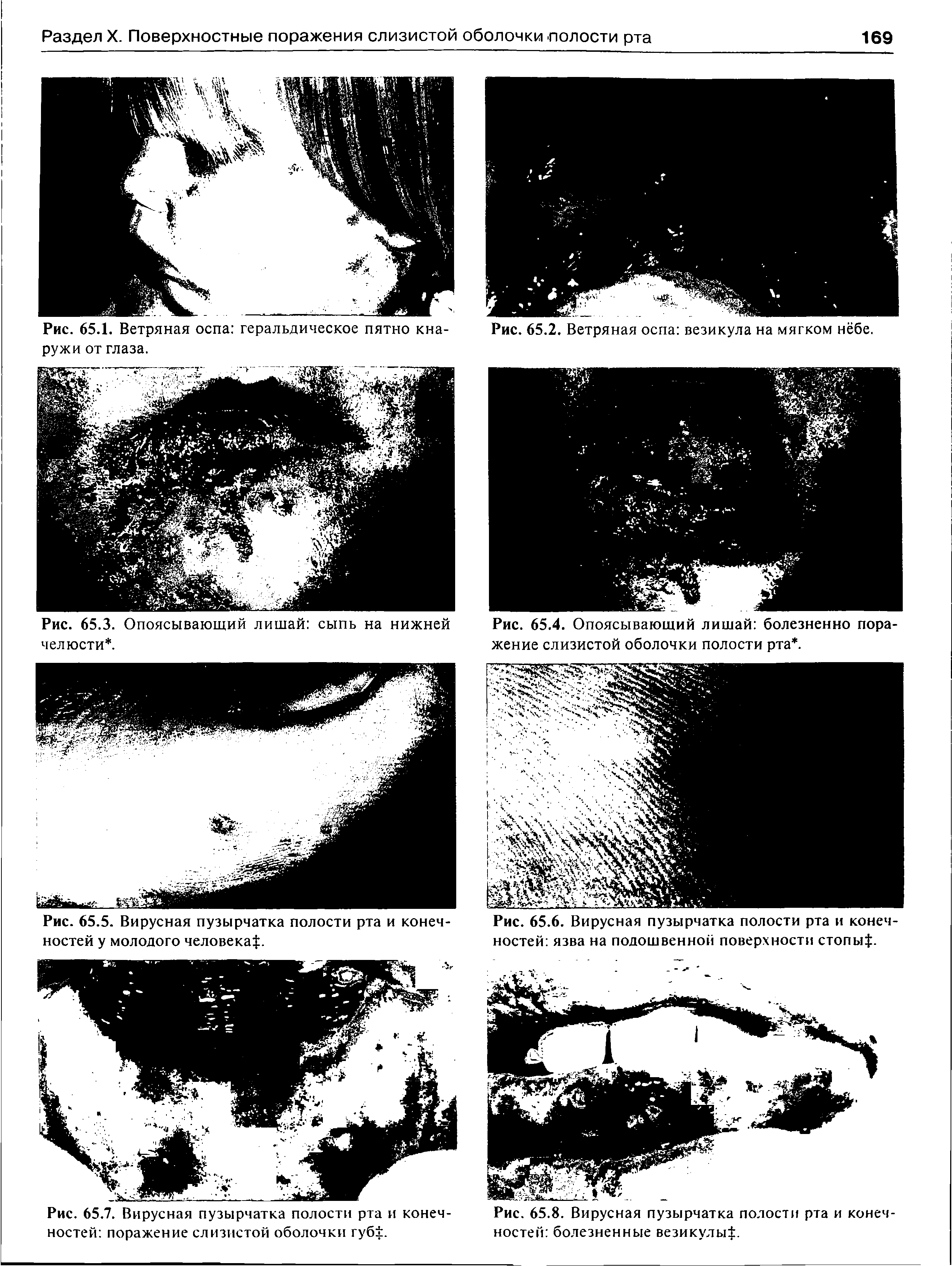 Рис. 65.5. Вирусная пузырчатка полости рта и конечностей у молодого человека. ...