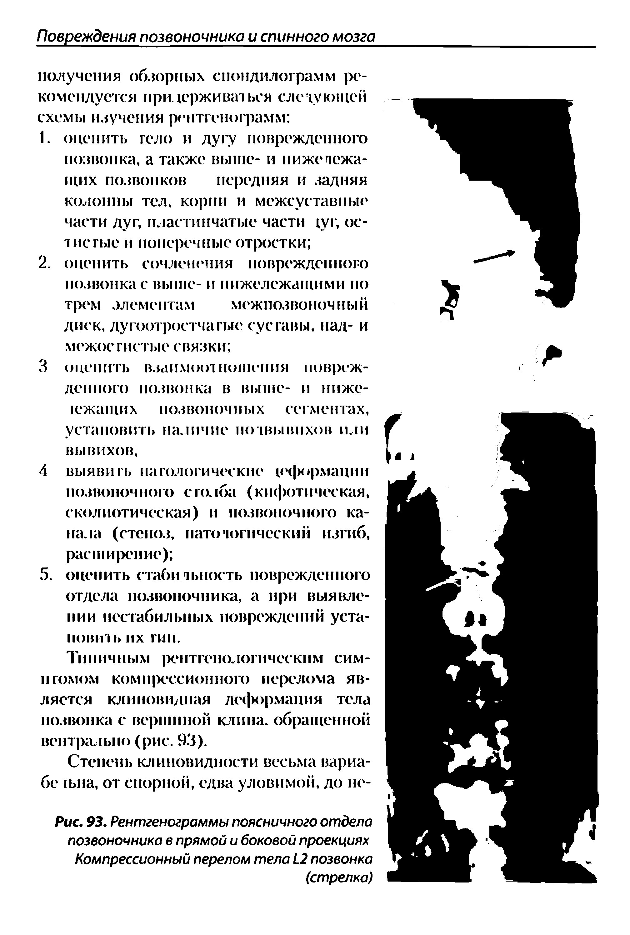 Рис. 93. Рентгенограммы поясничного отдела позвоночника в прямой и боковой проекциях Компрессионный перелом тела 1 2 позвонка (стрелка)...