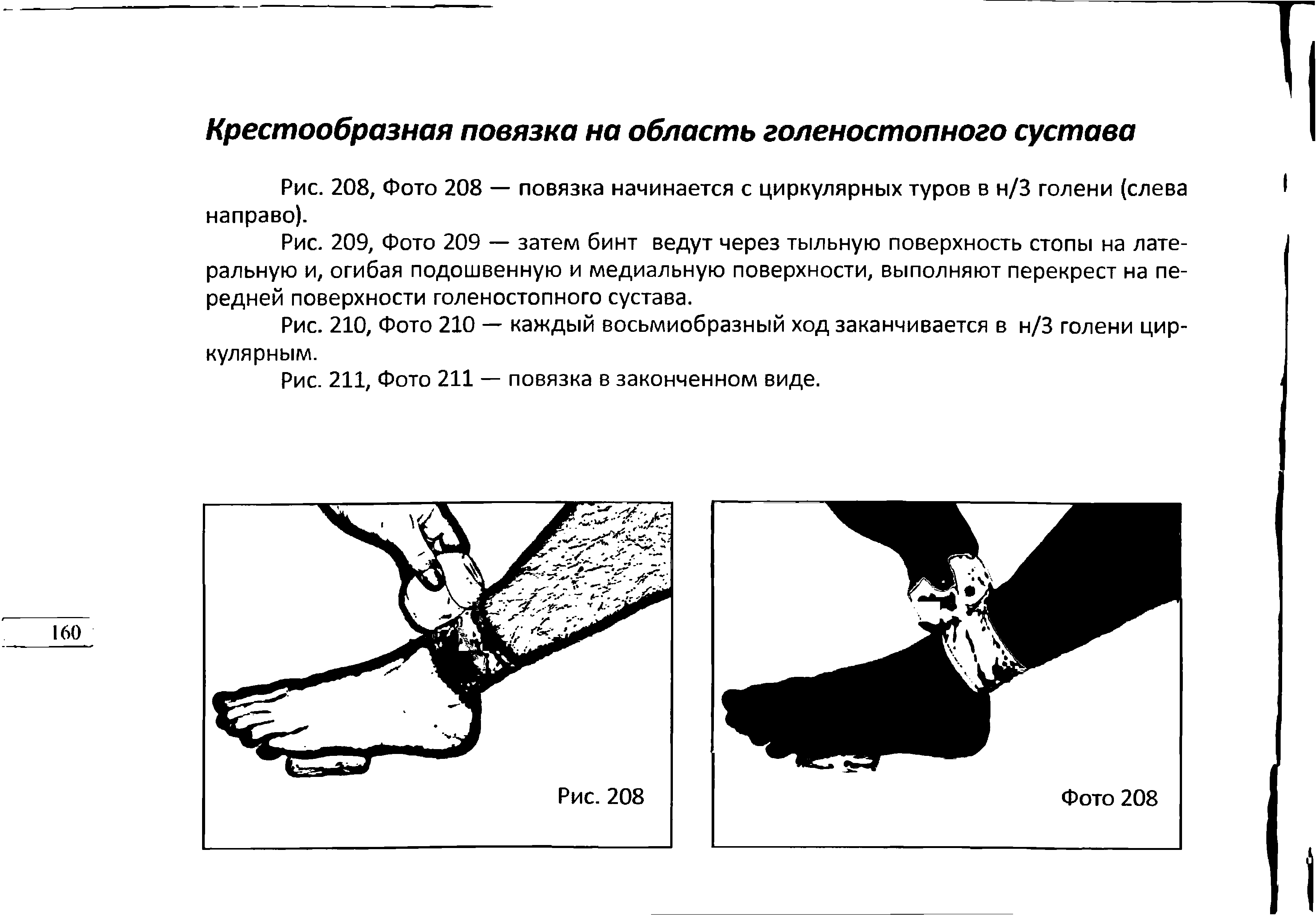 Рис. 209, Фото 209 — затем бинт ведут через тыльную поверхность стопы на латеральную и, огибая подошвенную и медиальную поверхности, выполняют перекрест на передней поверхности голеностопного сустава.