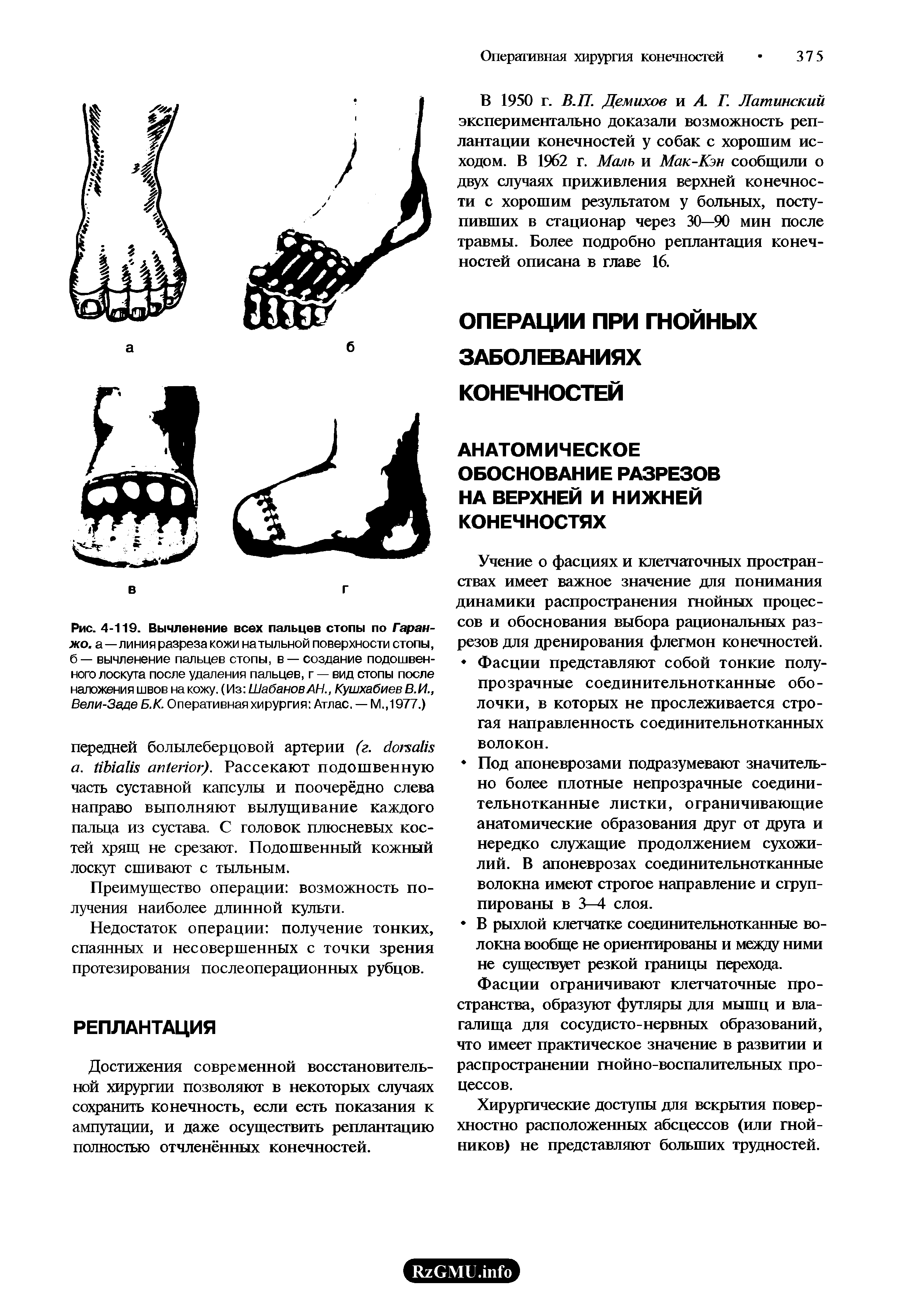 Рис. 4-119. Вычленение всех пальцев стопы по Гаран-жо. а—линия разреза кожи на тыльной поверхности стопы, б — вычленение пальцев стопы, в — создание подошвенного лоскута после удаления пальцев, г — вид стопы после наложения швов на кожу. (Из Шабанов АН., Кушхабиев В.И., Вели-Заде Б.К. Оперативная хирургия Атлас. — М.,1977.)...