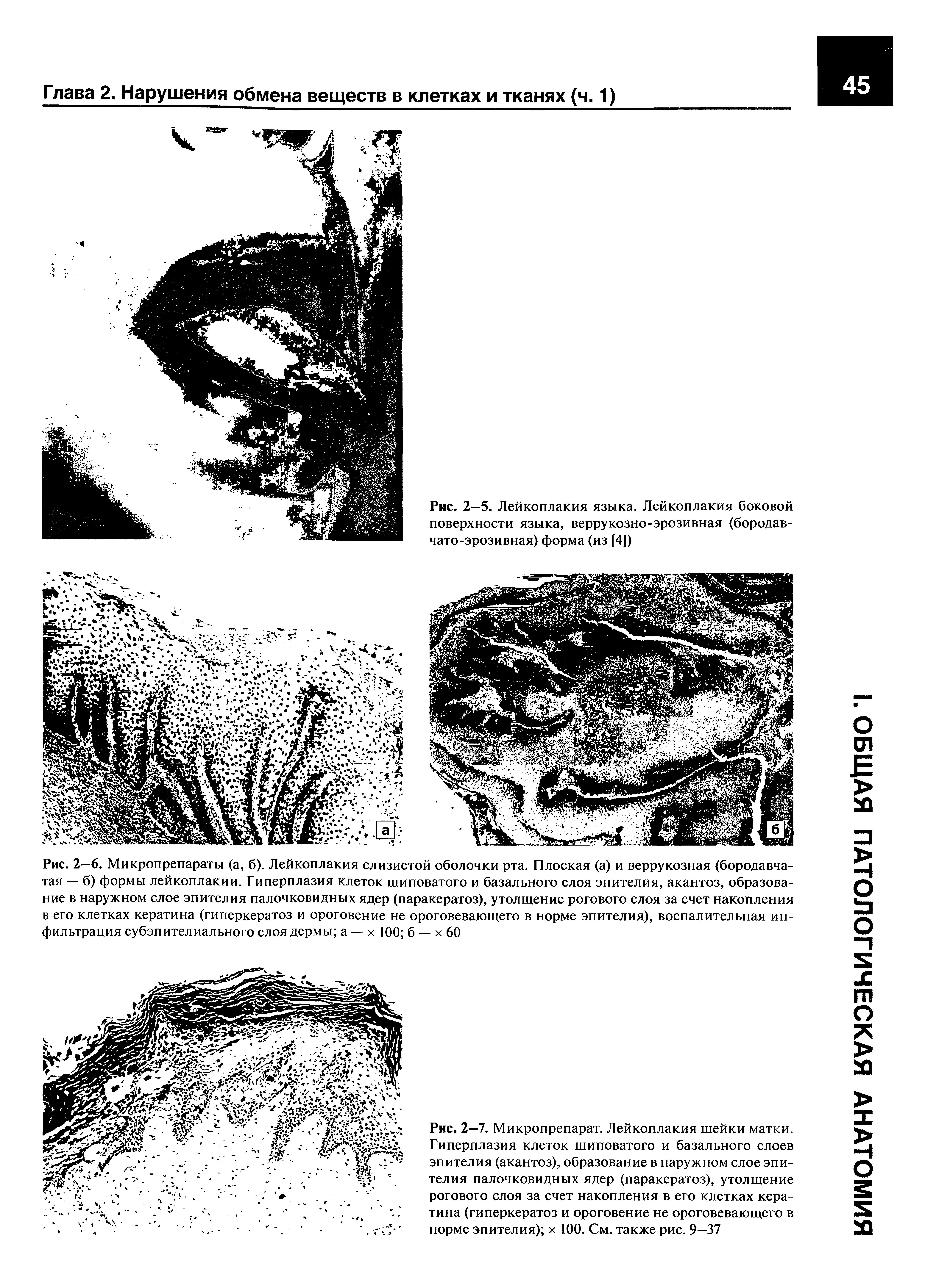 Рис. 2-5. Лейкоплакия языка. Лейкоплакия боковой поверхности языка, веррукозно-эрозивная (бородавчато-эрозивная) форма (из [4])...