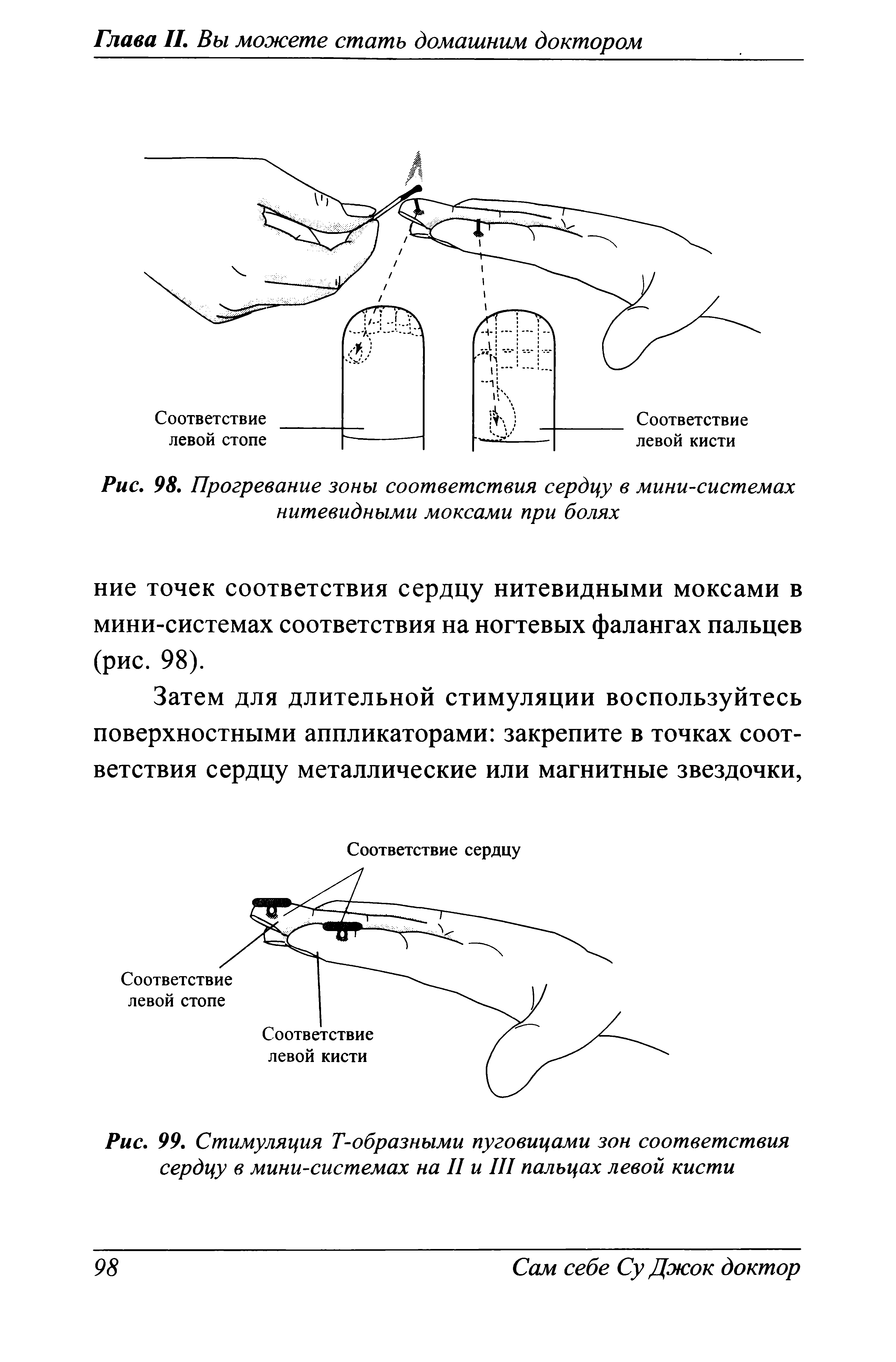 Рис. 99. Стимуляция Т-образными пуговицами зон соответствия сердцу в мини-системах на II и III пальцах левой кисти...
