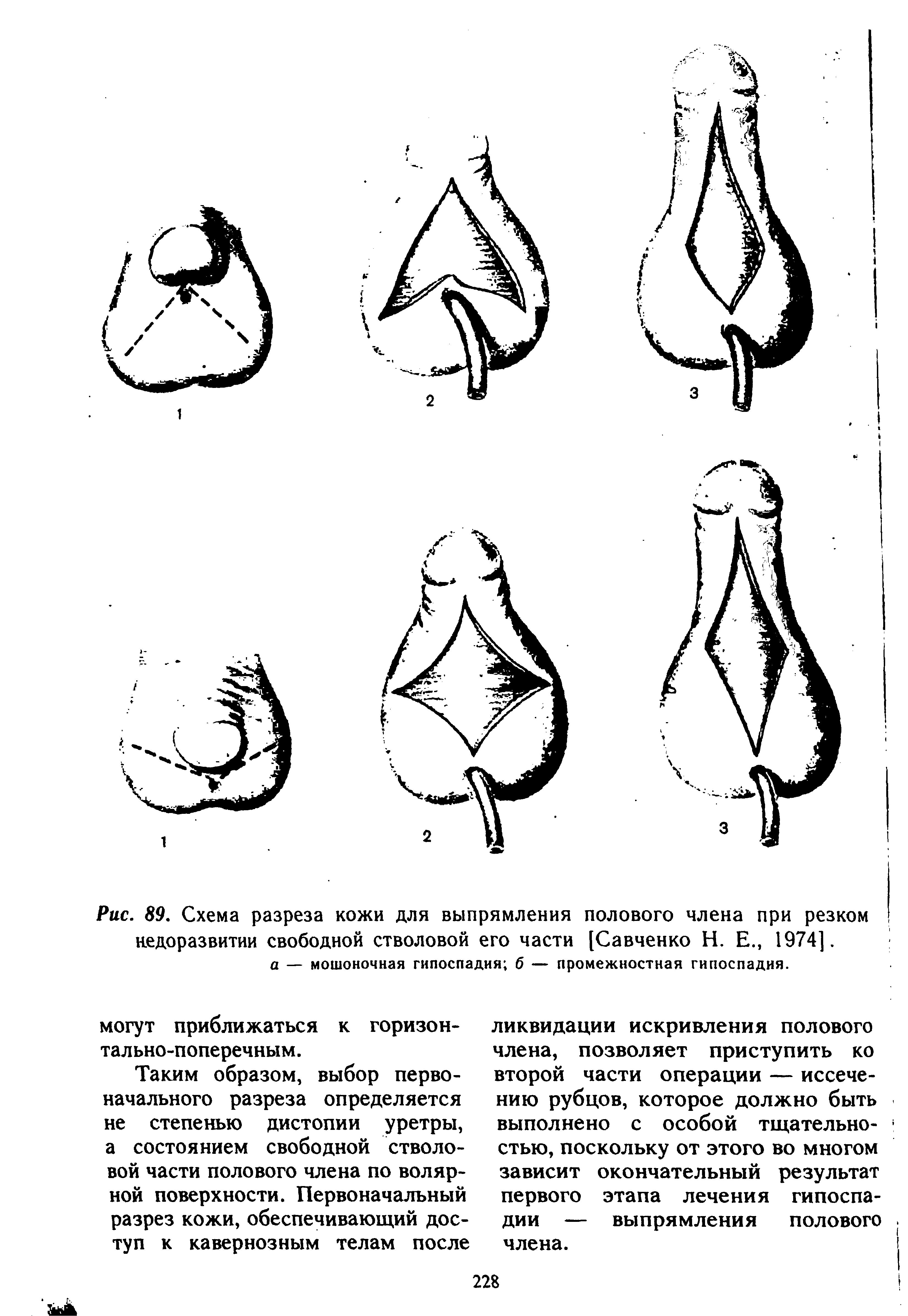 Рис. 89. Схема разреза кожи для выпрямления полового члена при резком недоразвитии свободной стволовой его части [Савченко Н. Е., 1974].