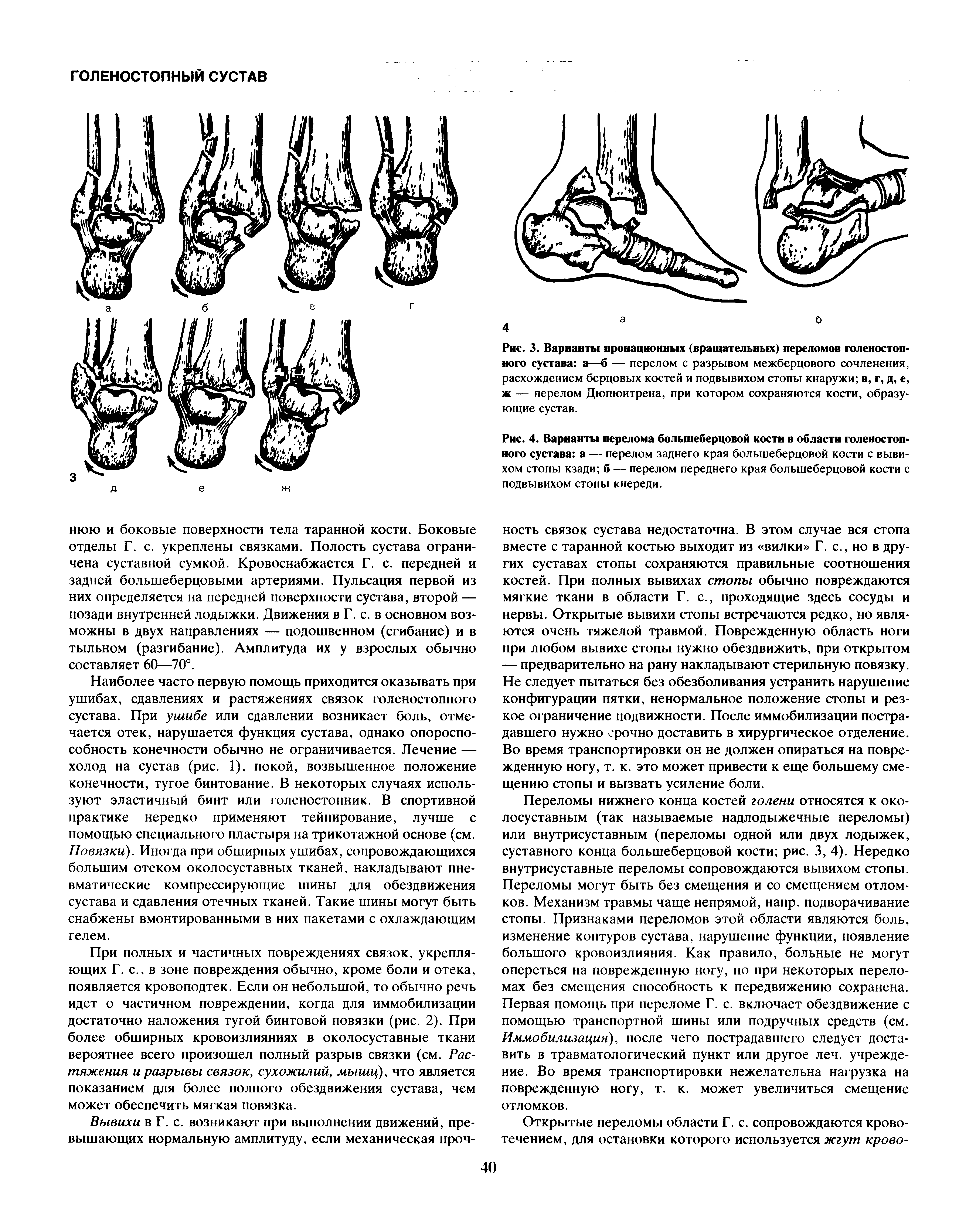 Рис. 3. Варианты пронационных (вращательных) переломов голеностопного сустава а—б — перелом с разрывом межберцового сочленения, расхождением берцовых костей и подвывихом стопы кнаружи в, г, д, е, ж — перелом Дюпюитрена, при котором сохраняются кости, образующие сустав.