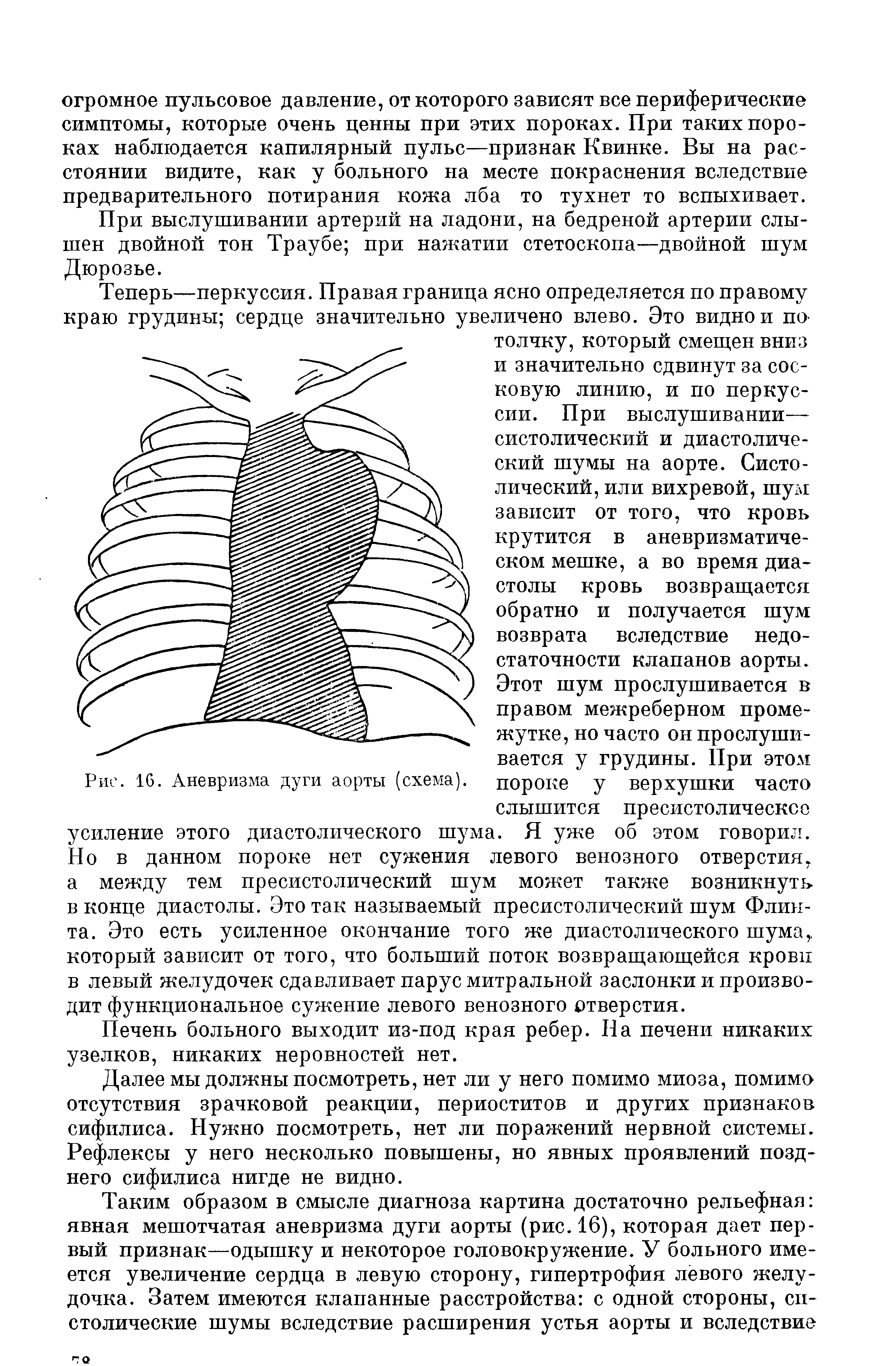 Рис. 16. Аневризма дуги аорты (схема), пороке у верхушки часто...