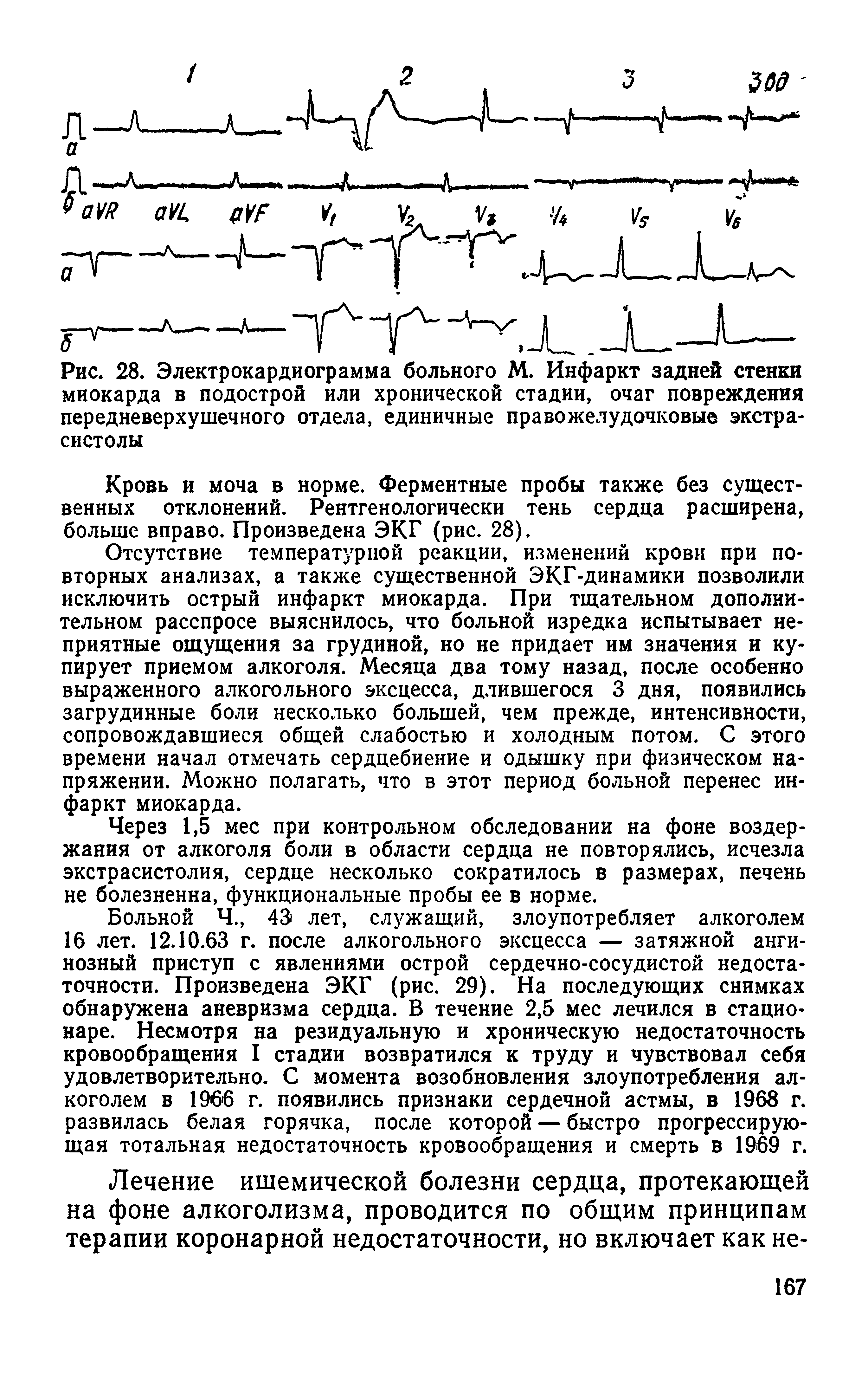 Рис. 28. Электрокардиограмма больного М. Инфаркт задней стенки миокарда в подострой или хронической стадии, очаг повреждения передневерхушечного отдела, единичные правожелудочковые экстрасистолы...