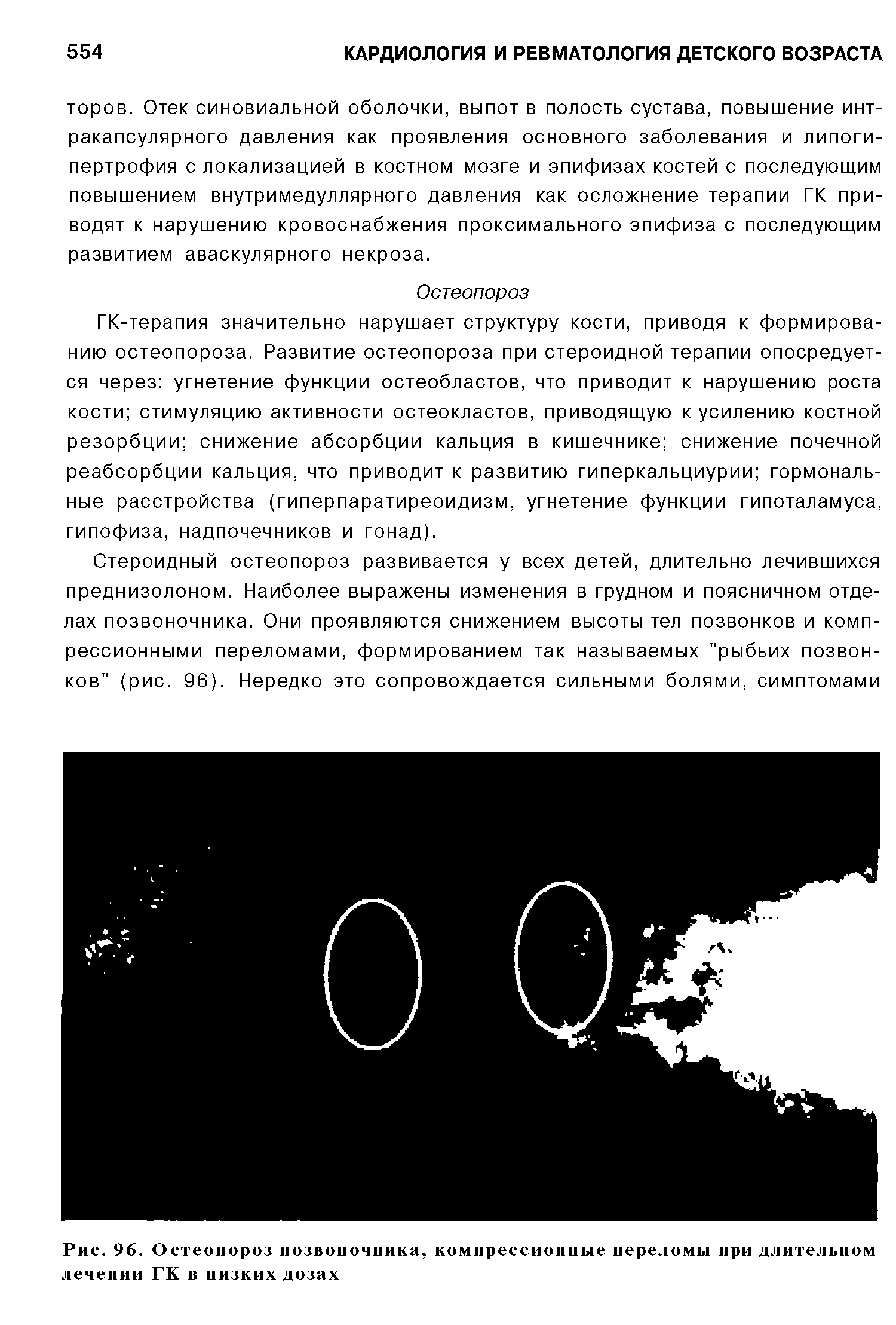 Рис. 96. Остеопороз позвоночника, компрессионные переломы при длительном лечении ГК в низких дозах...