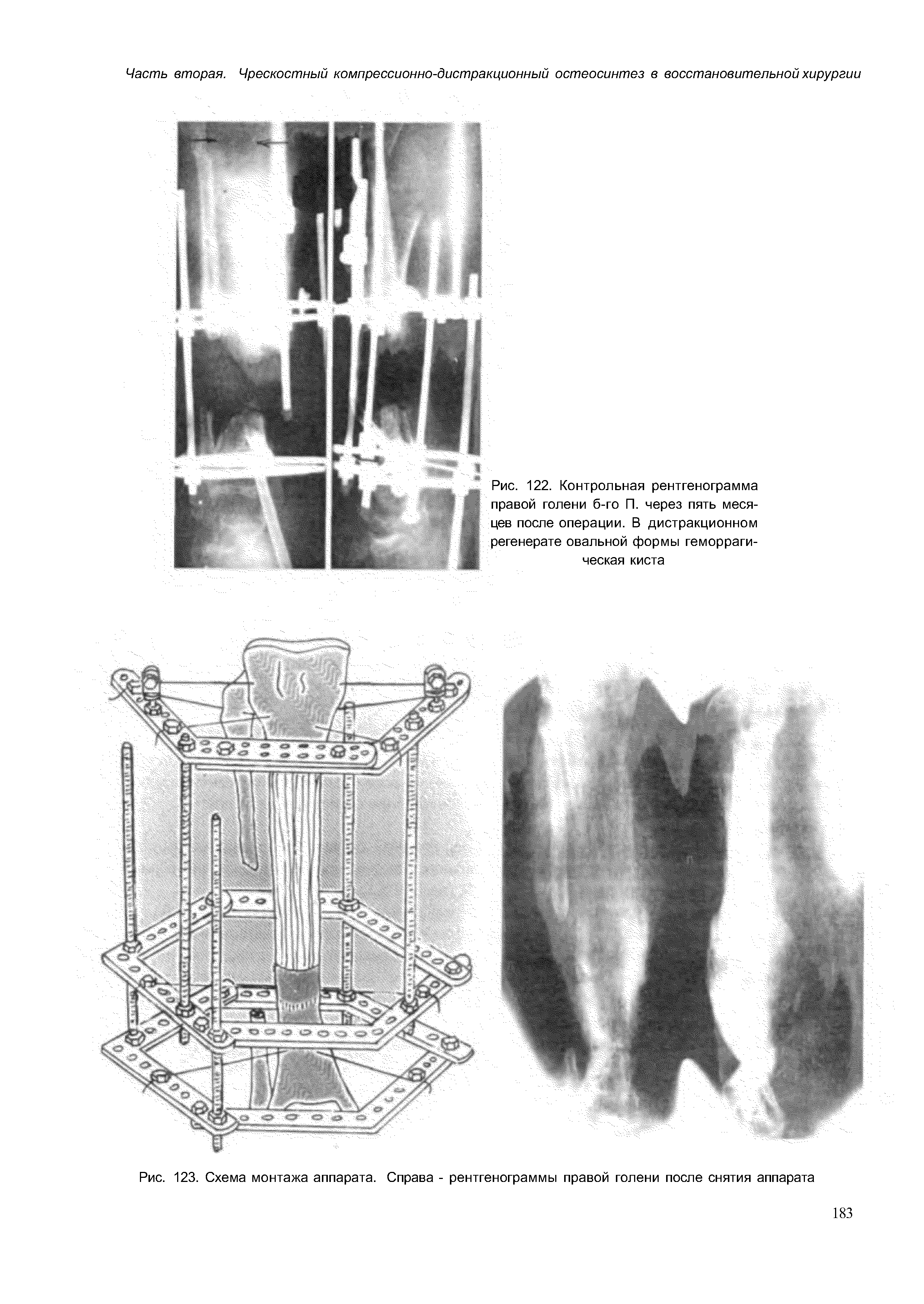 Рис. 123. Схема монтажа аппарата. Справа - рентгенограммы правой голени после снятия аппарата...