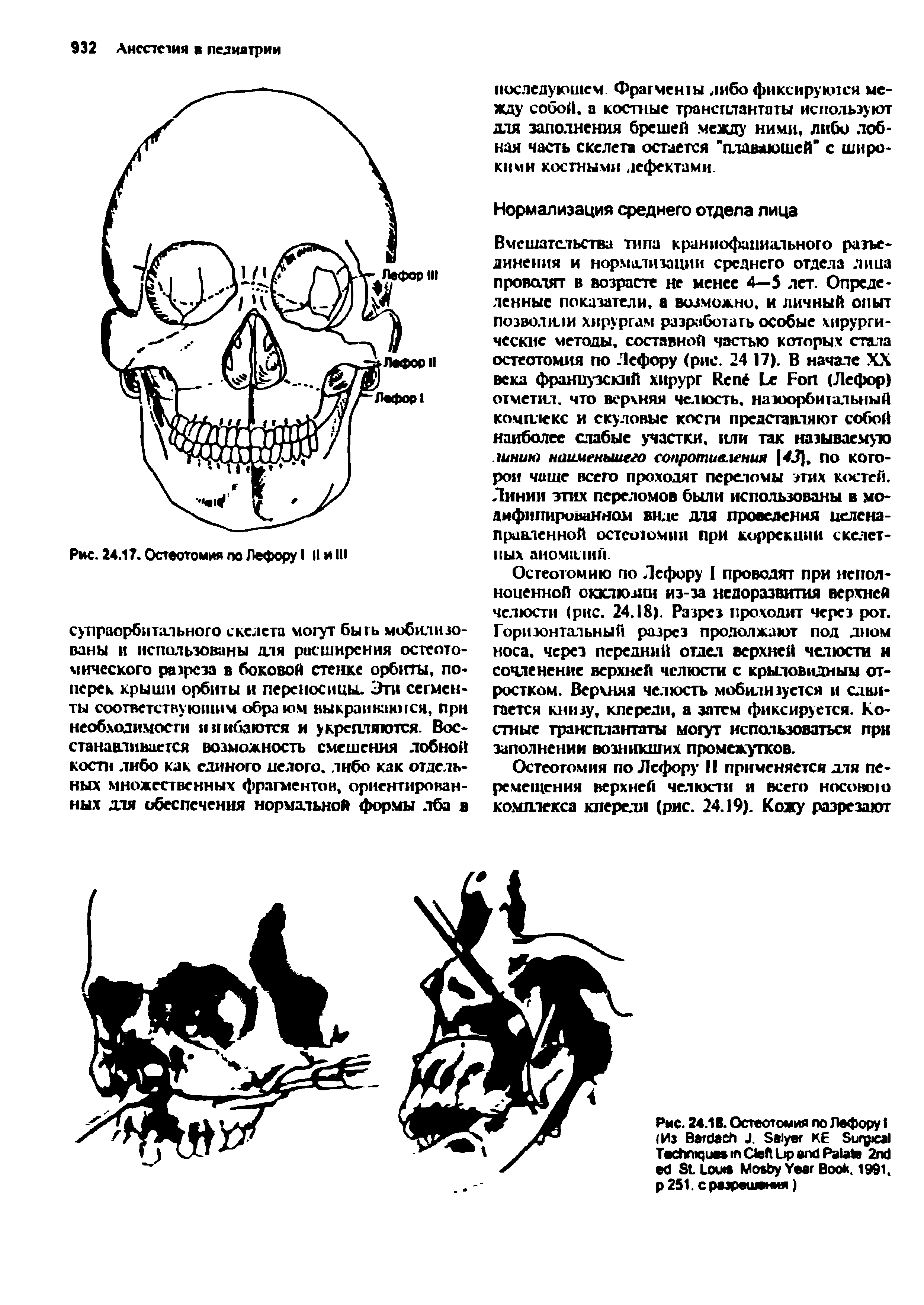 Рис. 24.18. Остеотомия по Лефору I (Из B J, S KE S T C L P 2 S L M Y B . 1991. 251. с разрешения)...