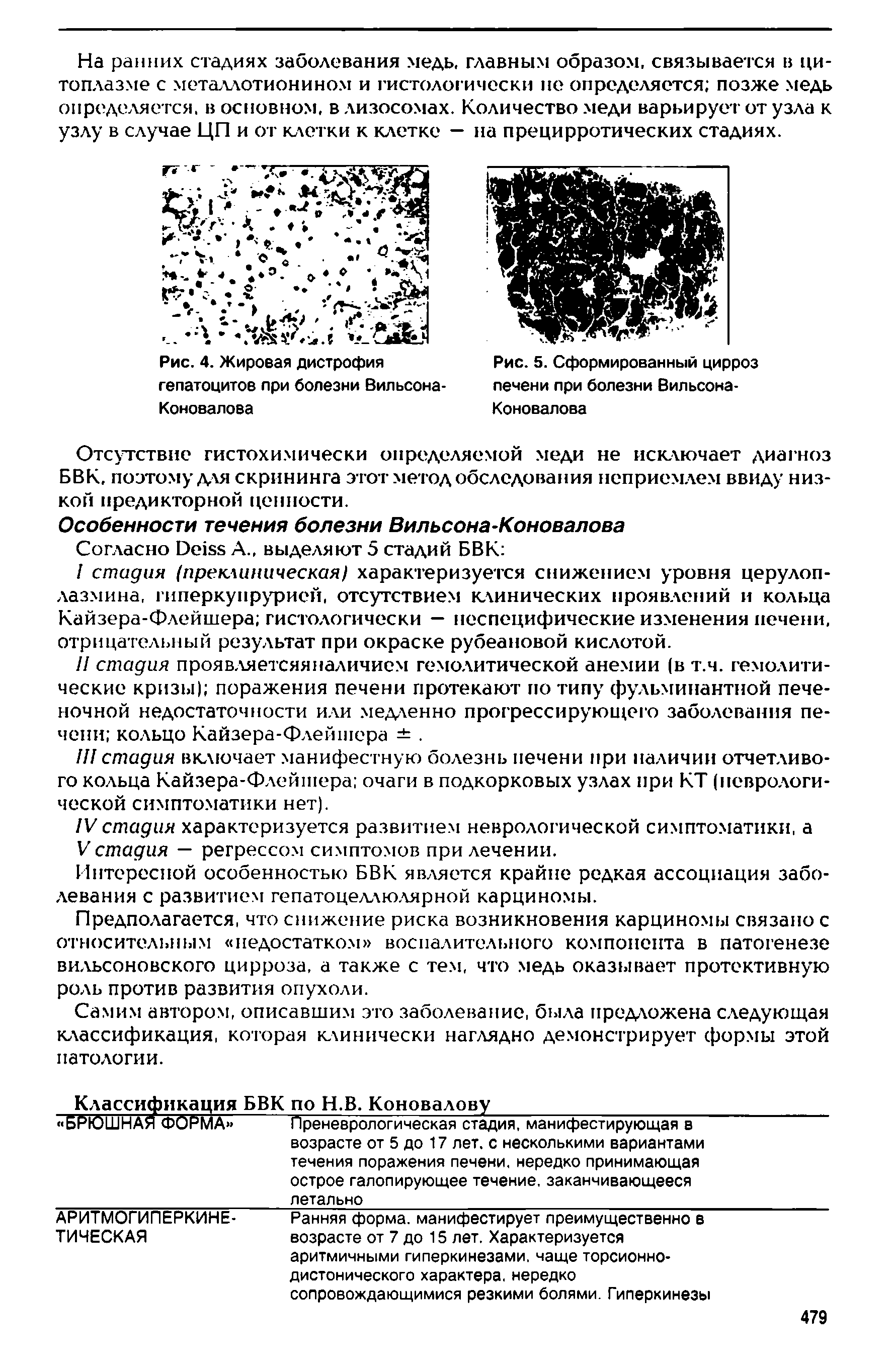 Рис. 5. Сформированный цирроз печени при болезни Вильсона-Коновалова...