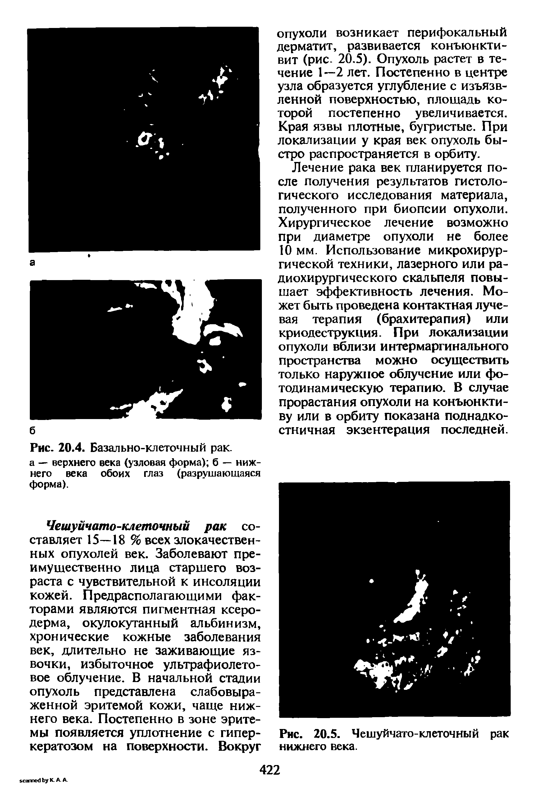 Рис. 20.4. Базально-клеточный рак. а — верхнего века (узловая форма) б — нижнего века обоих глаз (разрушающаяся форма).