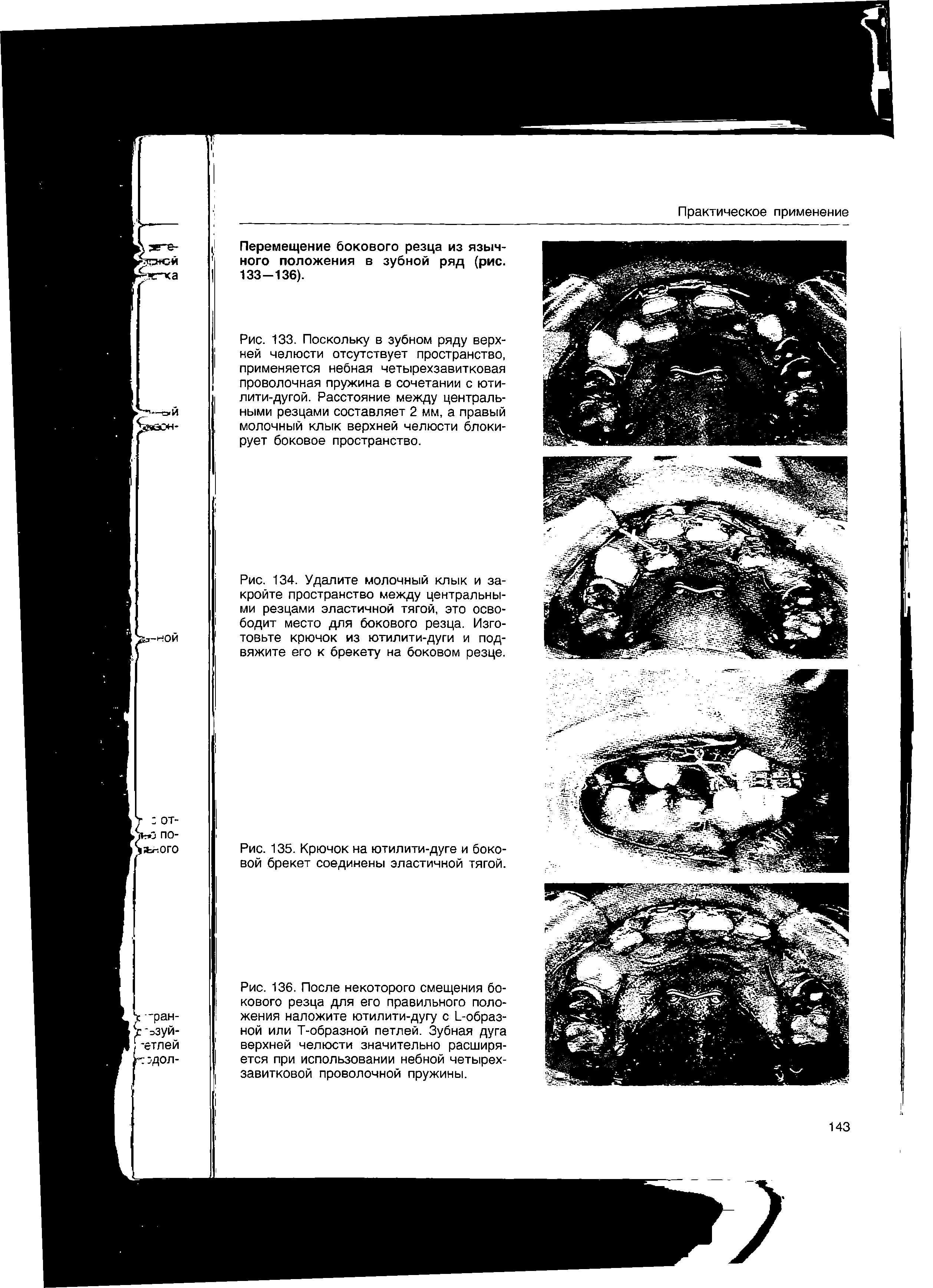 Рис. 133. Поскольку в зубном ряду верхней челюсти отсутствует пространство, применяется небная четырехзавитковая проволочная пружина в сочетании с юти-лити-дугой. Расстояние между центральными резцами составляет 2 мм, а правый молочный клык верхней челюсти блокирует боковое пространство.