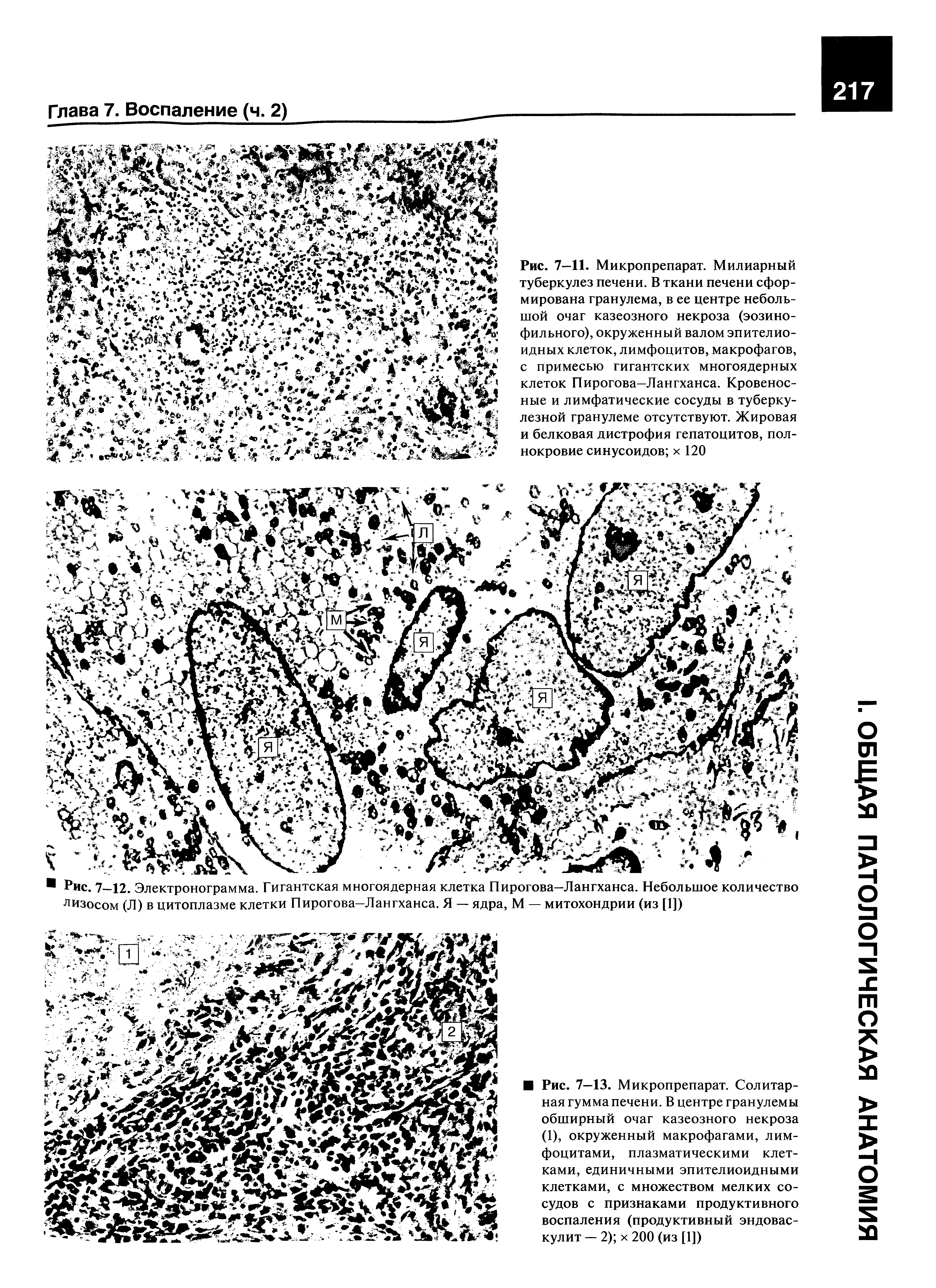 Рис. 7—12. Электронограмма. Гигантская многоядерная клетка Пирогова—Лангханса. Небольшое количество лизосом (Л) в цитоплазме клетки Пирогова-Лангханса. Я — ядра, М — митохондрии (из [1])...