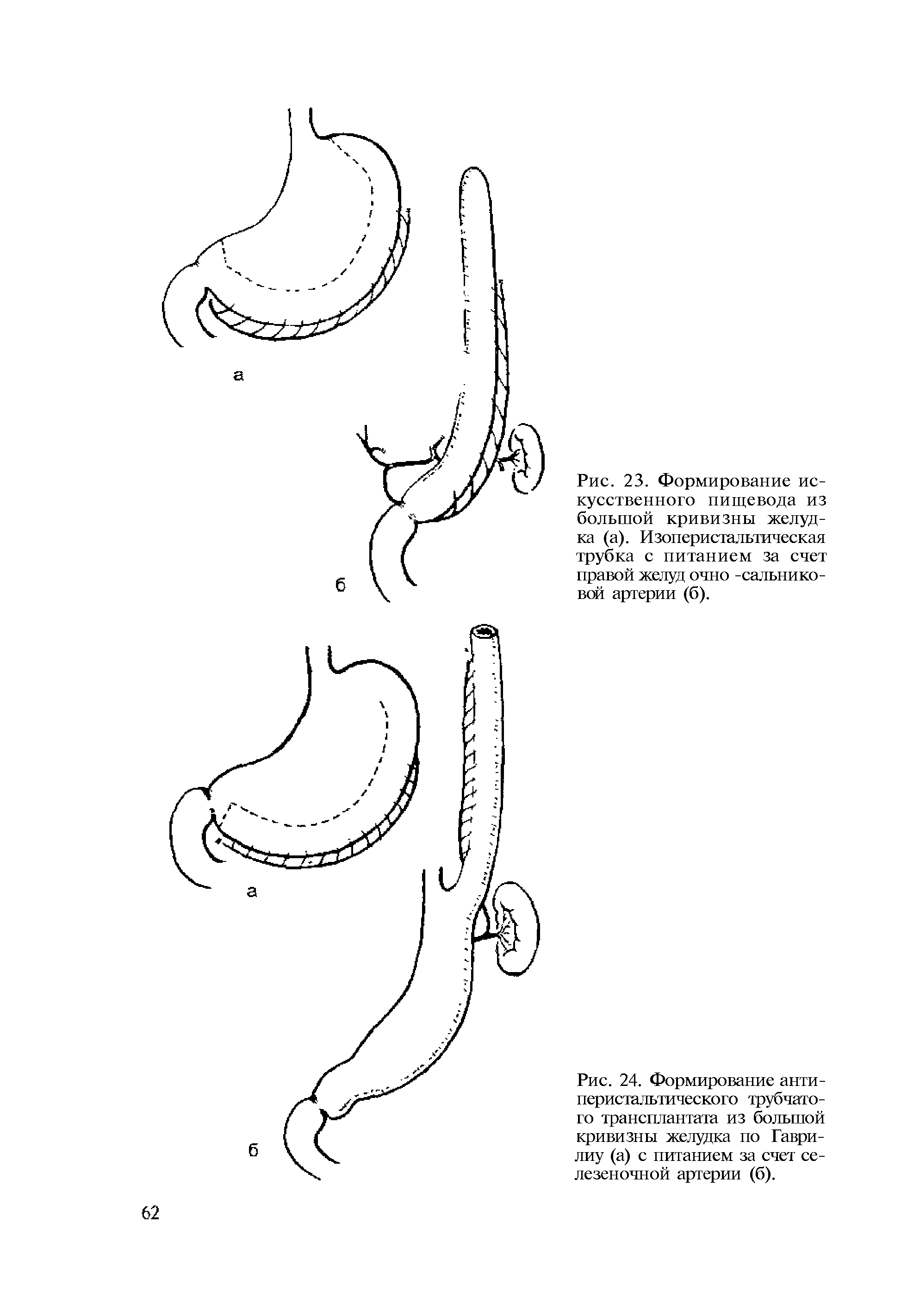 Рис. 24. Формирование анти-перистальтического трубчатого трансплантата из большой кривизны желудка по Гаври-лиу (а) с питанием за счет селезеночной артерии (б).
