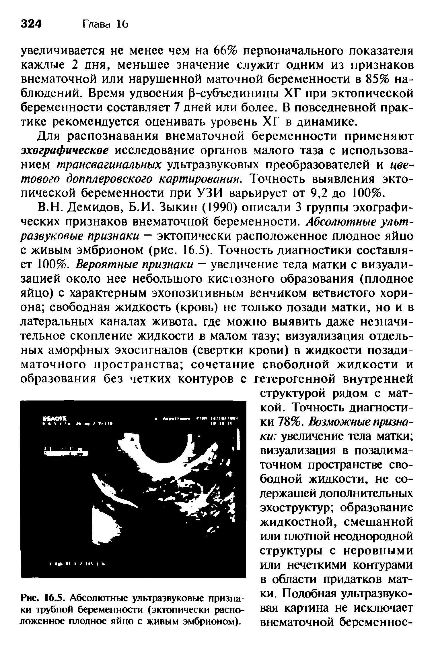 Рис. 16.5. Абсолютные ультразвуковые признаки трубной беременности (эктопически расположенное плодное яйцо с живым эмбрионом).