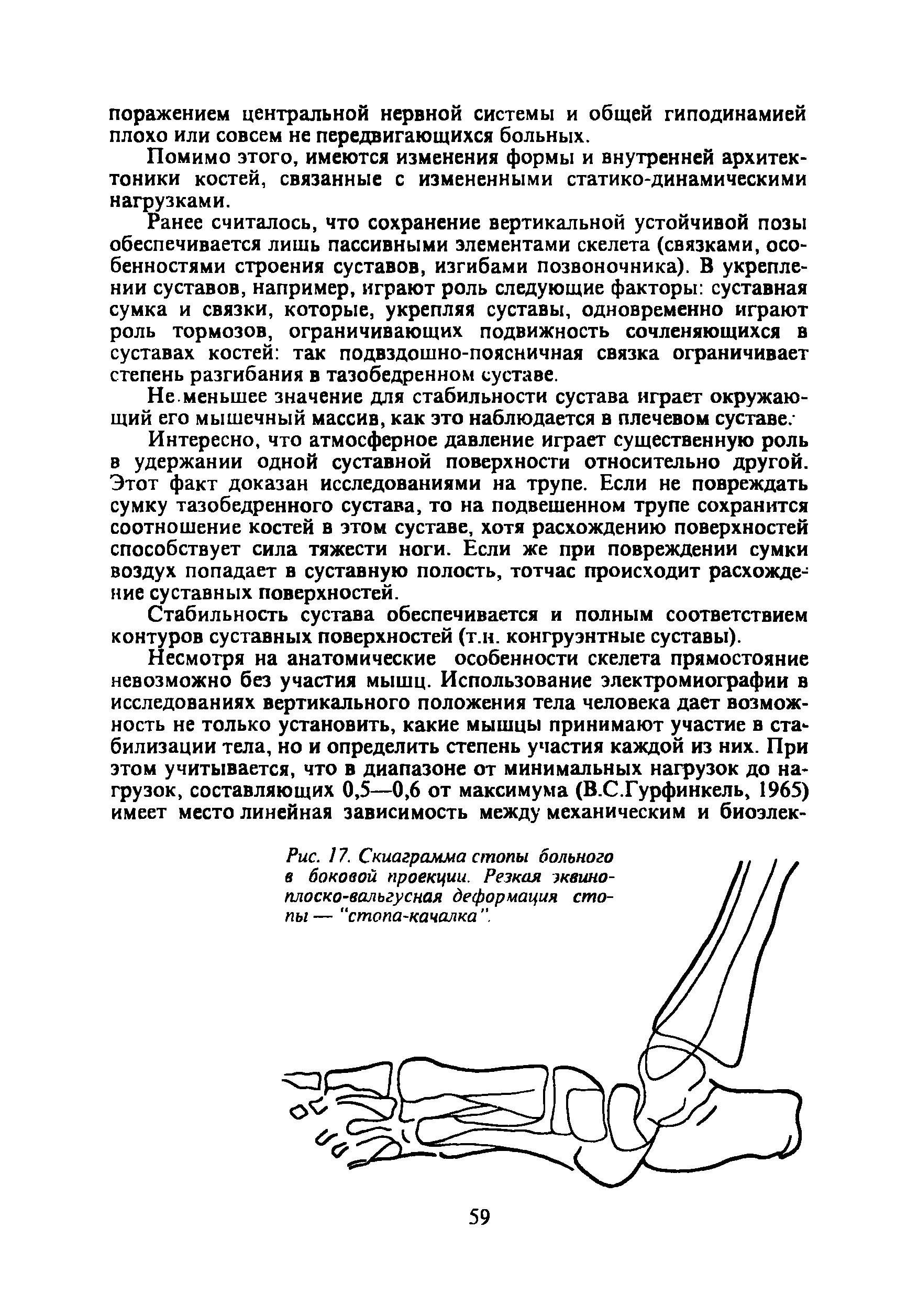 Рис. 17. Скиаграмма стопы больного в боковой проекции. Резкая эквино-плоско-валъгусная деформация стопы — "стопа-качалка ".