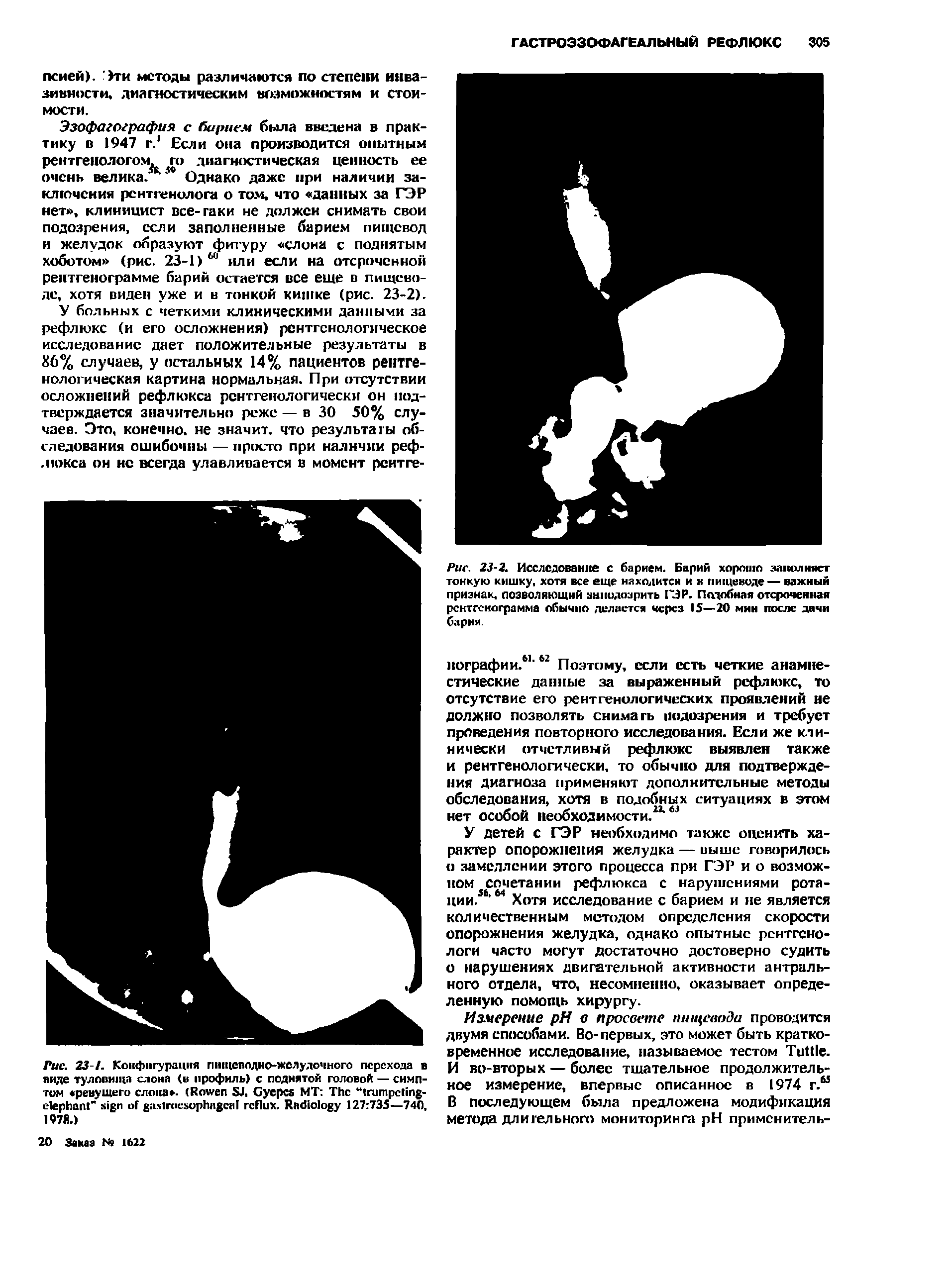 Рис. 23-2. Исследование с барием. Барий хорошо заполняет тонкую кишку, хотя все еще находится и и пищеводе— важный признак, позволяющий заподозрить ГЭР. Подобная отсроченная рентгенограмма обычно делается через 15—20 мин после дачи бария.