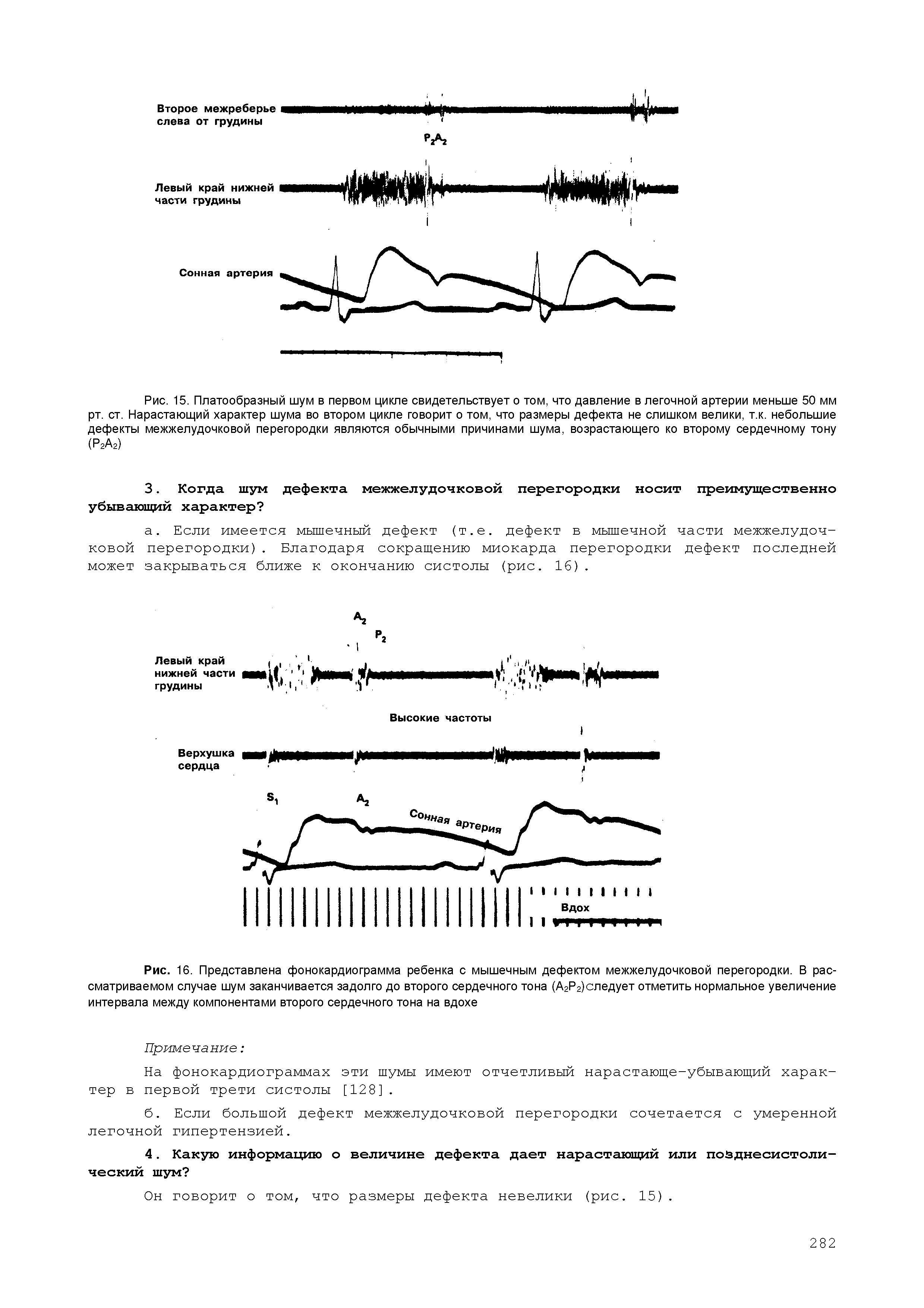 Рис. 16. Представлена фонокардиограмма ребенка с мышечным дефектом межжелудочковой перегородки. В рассматриваемом случае шум заканчивается задолго до второго сердечного тона (А2Р2)следует отметить нормальное увеличение интервала между компонентами второго сердечного тона на вдохе...