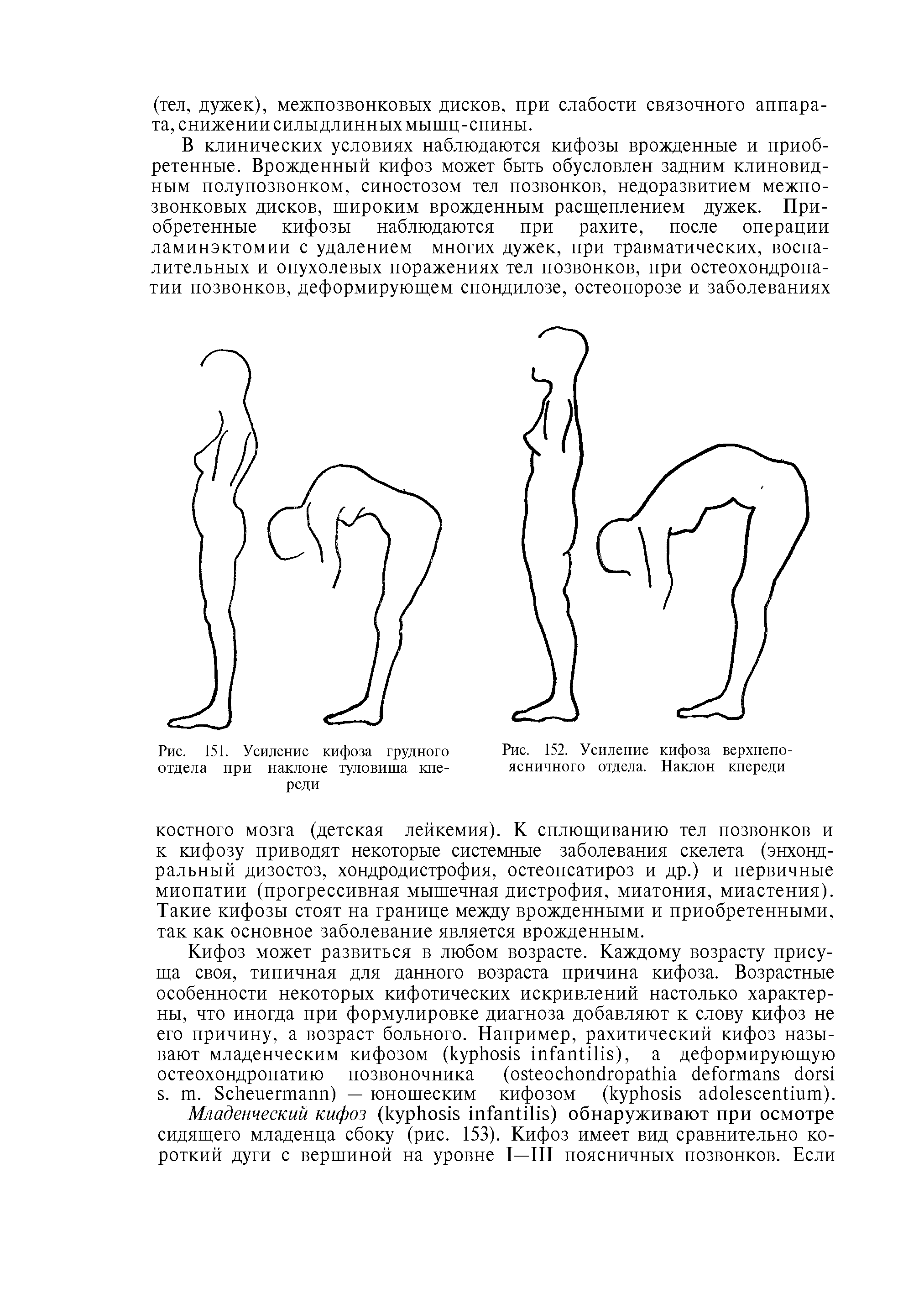 Рис. 151. Усиление кифоза грудного отдела при наклоне туловища кпереди...