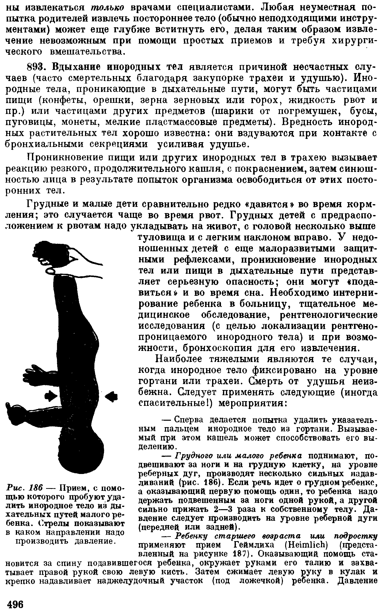 Рис. 186 — Прием, с помощью которого пробуют удалить инородное тело из дыхательных путей малого ребенка. Стрелы показывают в каком направлении надо производить давление.