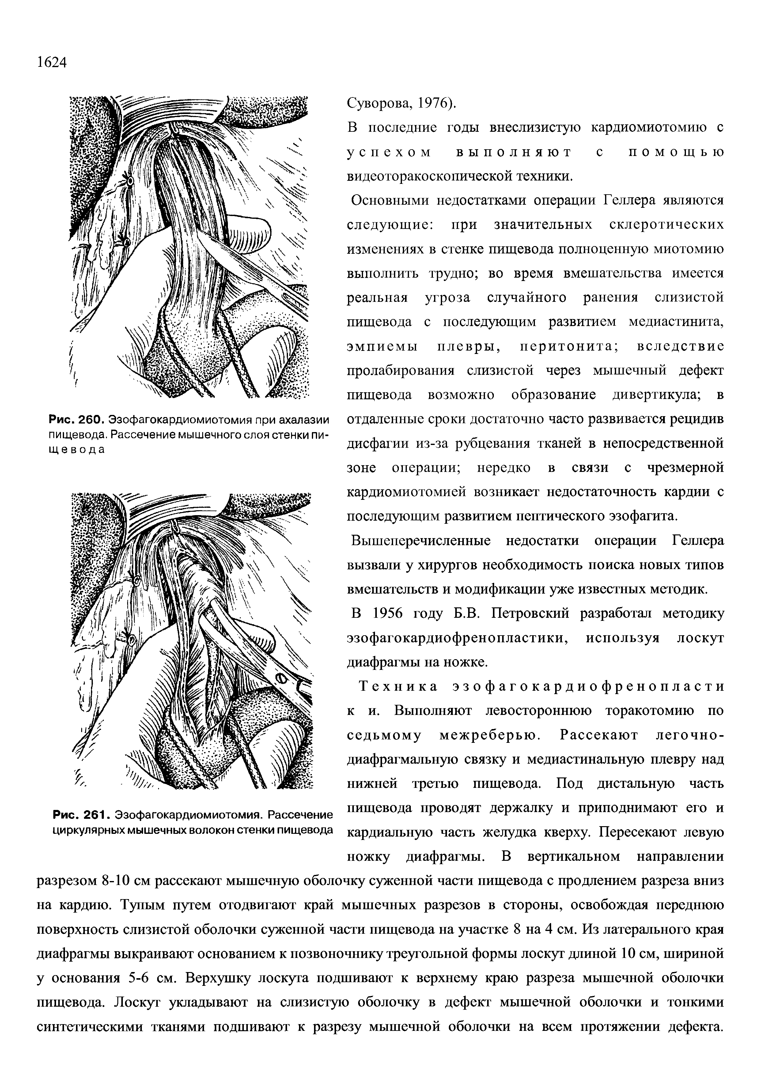 Рис. 261. Эзофагокардиомиотомия. Рассечение циркулярных мышечных волокон стенки пищевода...