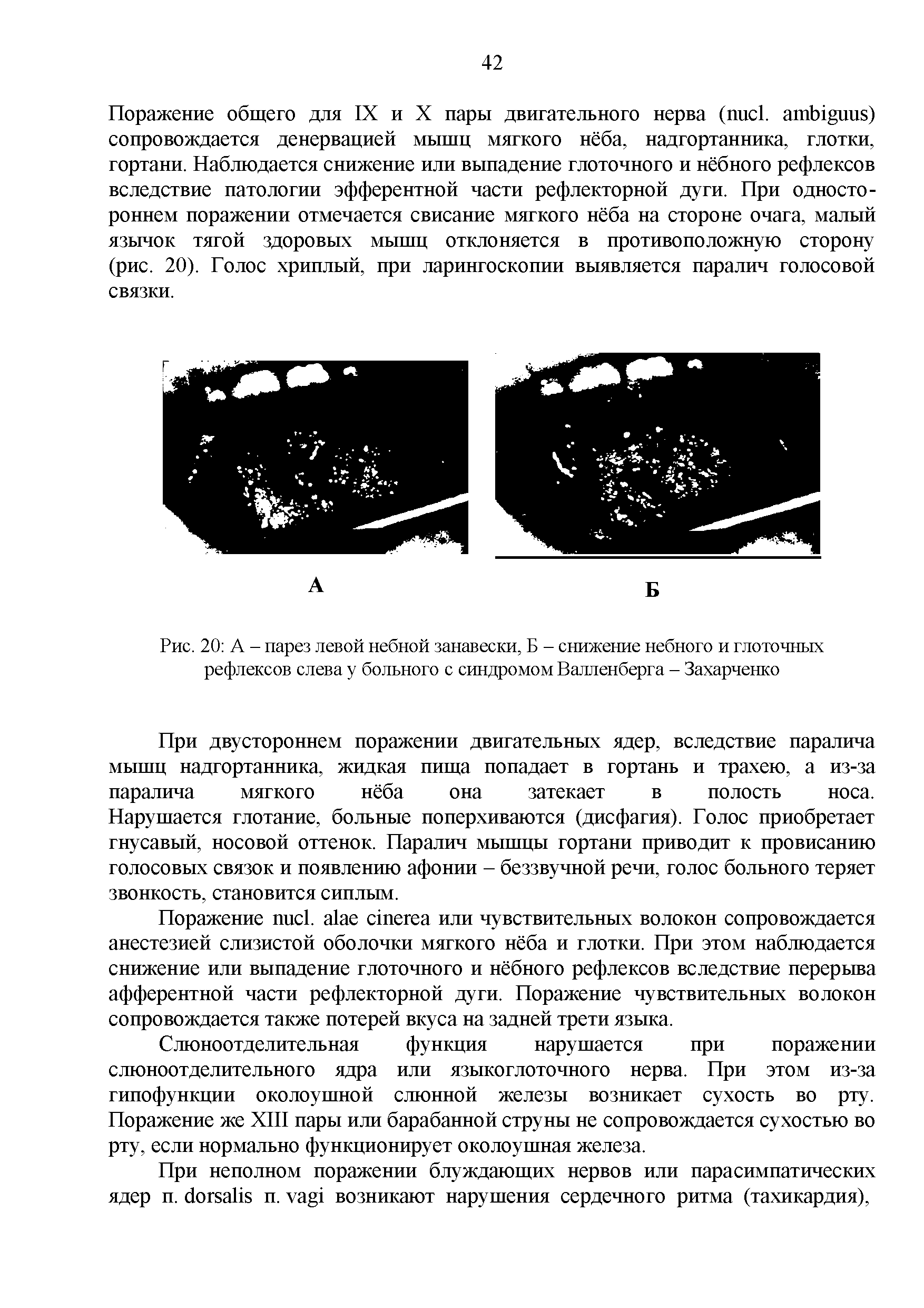 Рис. 20 А - парез левой небной занавески, Б - снижение небного и глоточных рефлексов слева у больного с синдромом Валленберга - Захарченко...