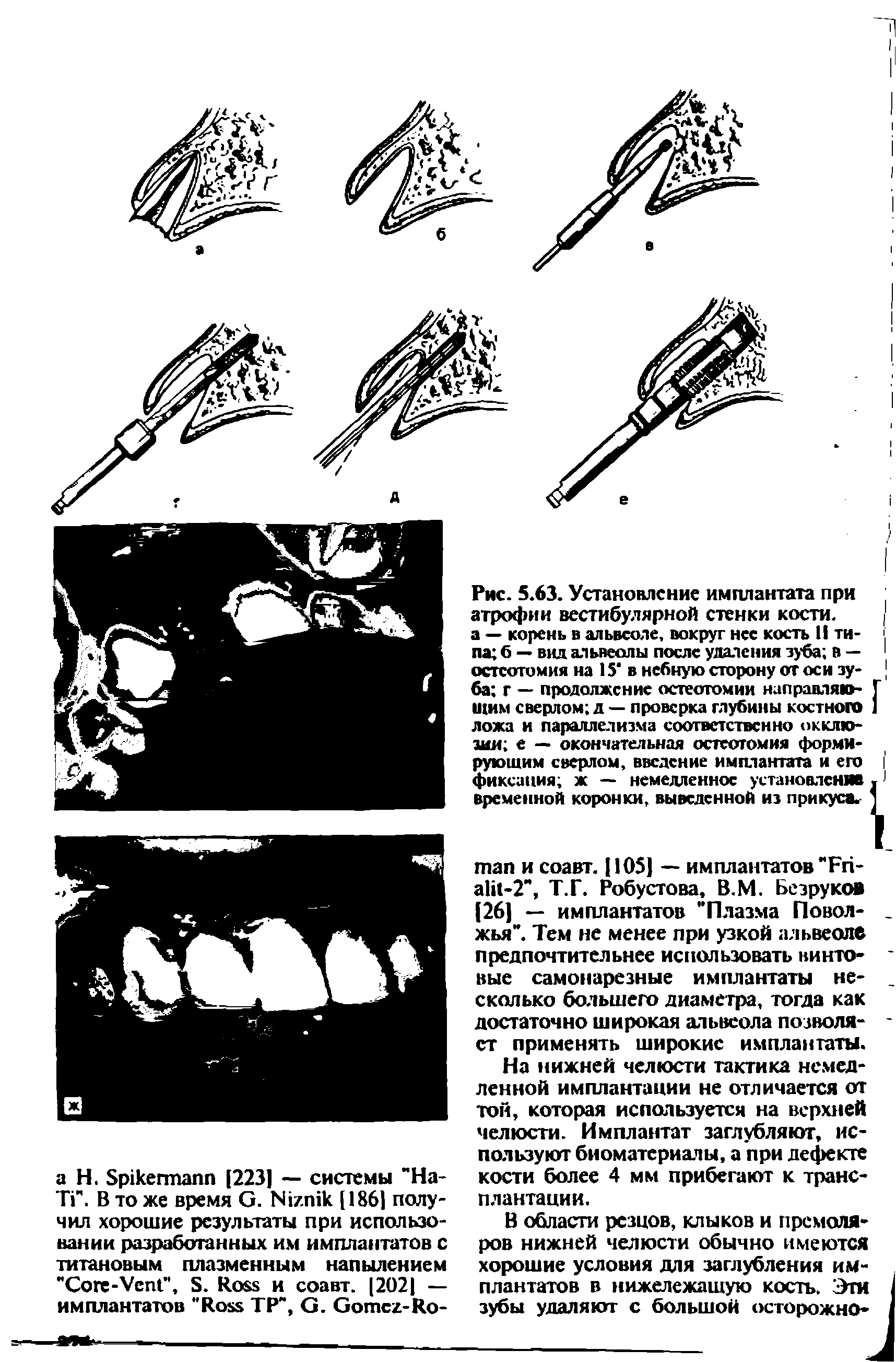 Рис. 5.63. Установление имплантата при атрофии вестибулярной стенки кости. [ а — корень в альвеоле, вокруг нес кость II ти-па б — вид альвеолы после удаления зуба в — 1...