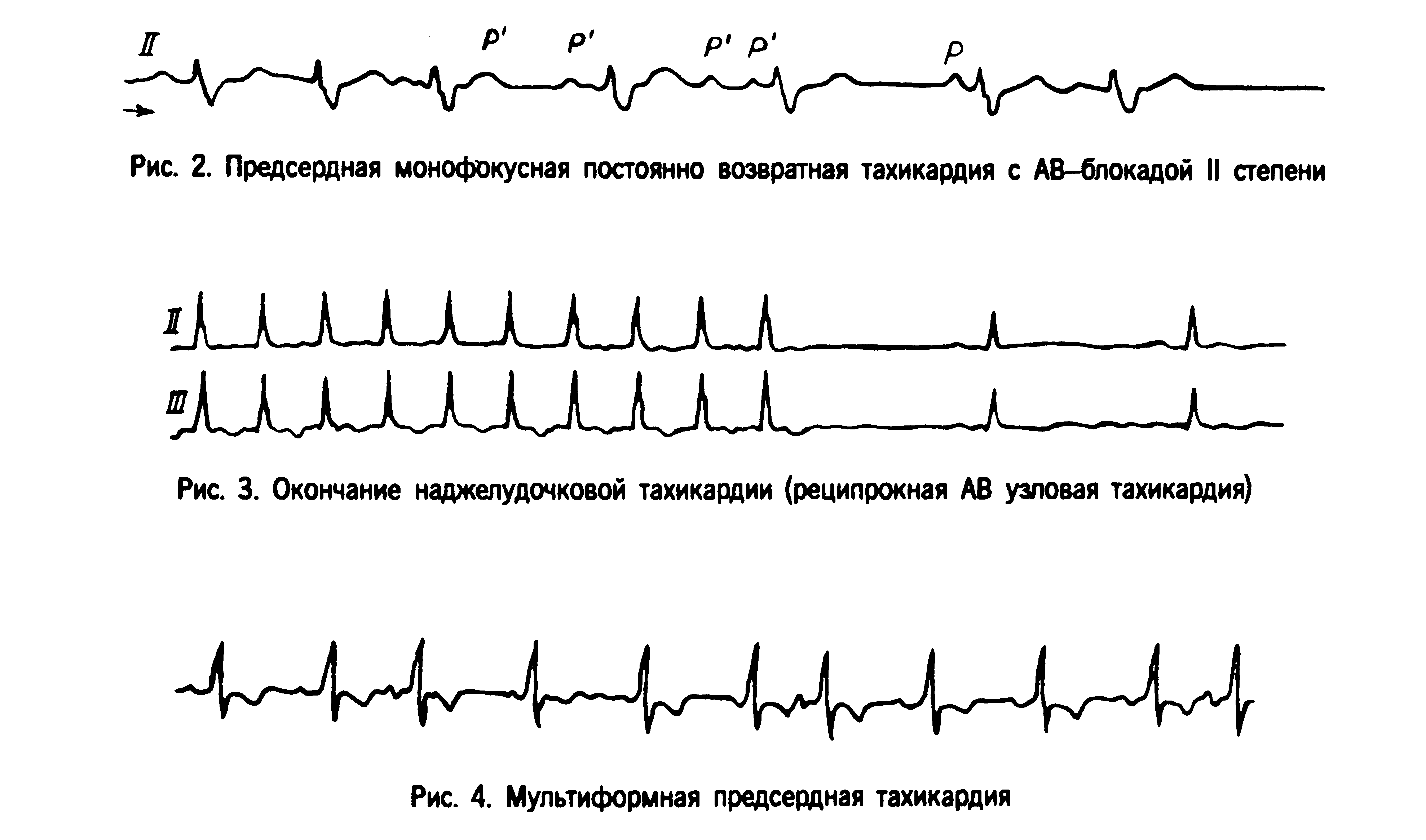 Рис. 3. Окончание наджелудочковой тахикардии (реципрокная АВ узловая тахикардия)...