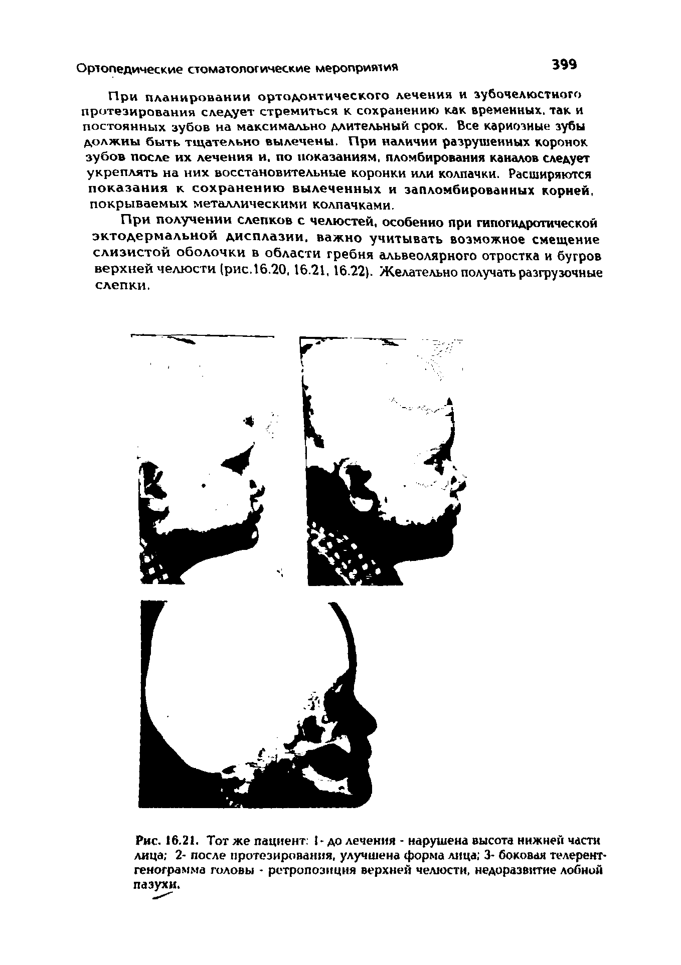 Рис. 16.21. Тот же пациент I-до лечения - нарушена высота нижней части лица 2- после протезирования, улучшена форма лица 3- боковая телерентгенограмма головы - ретропозиция верхней челюсти, недоразвитие лобной пазухи.