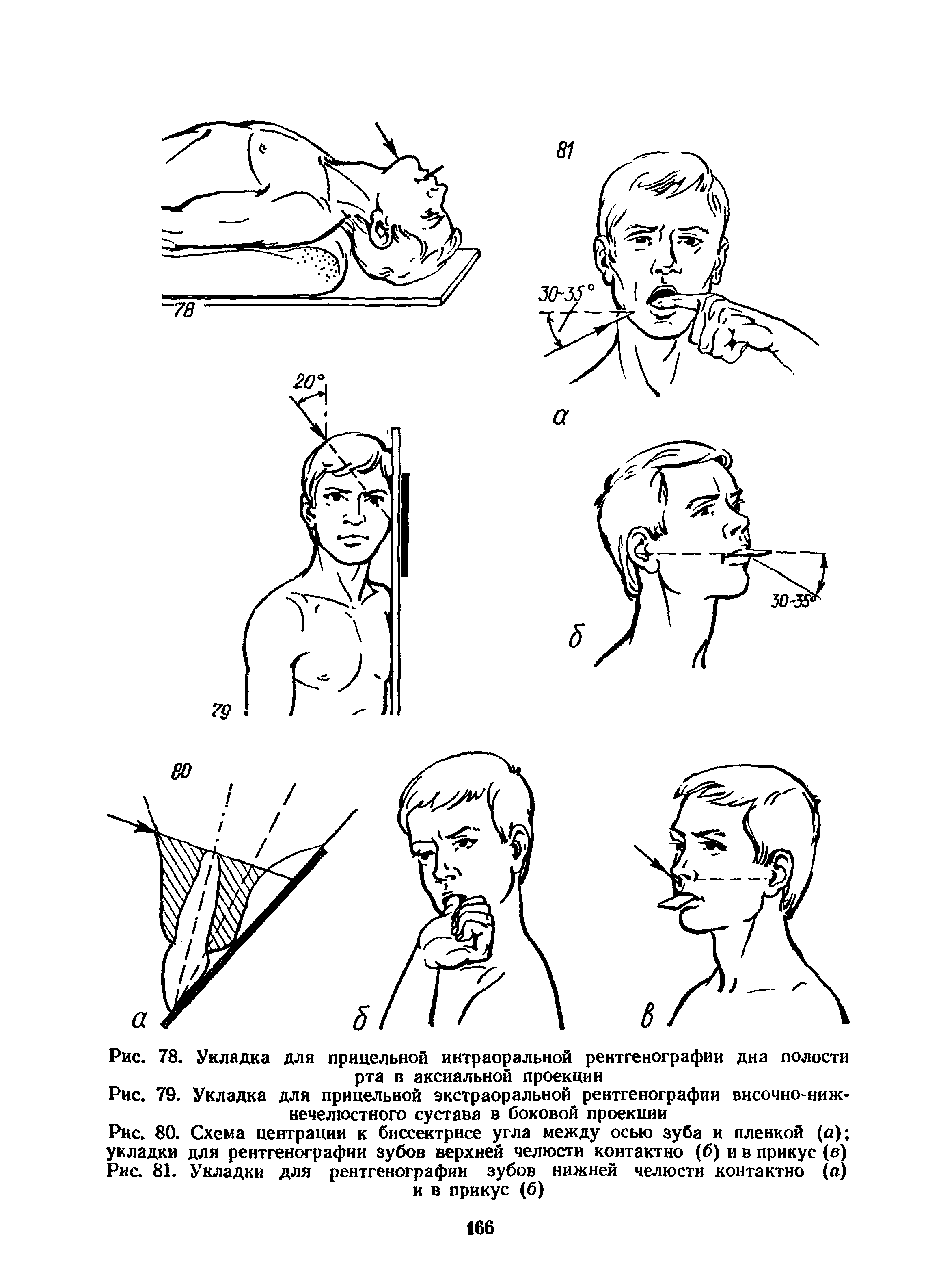 Рис. 79. Укладка для прицельной экстраоральной рентгенографии височно-нижнечелюстного сустава в боковой проекции...