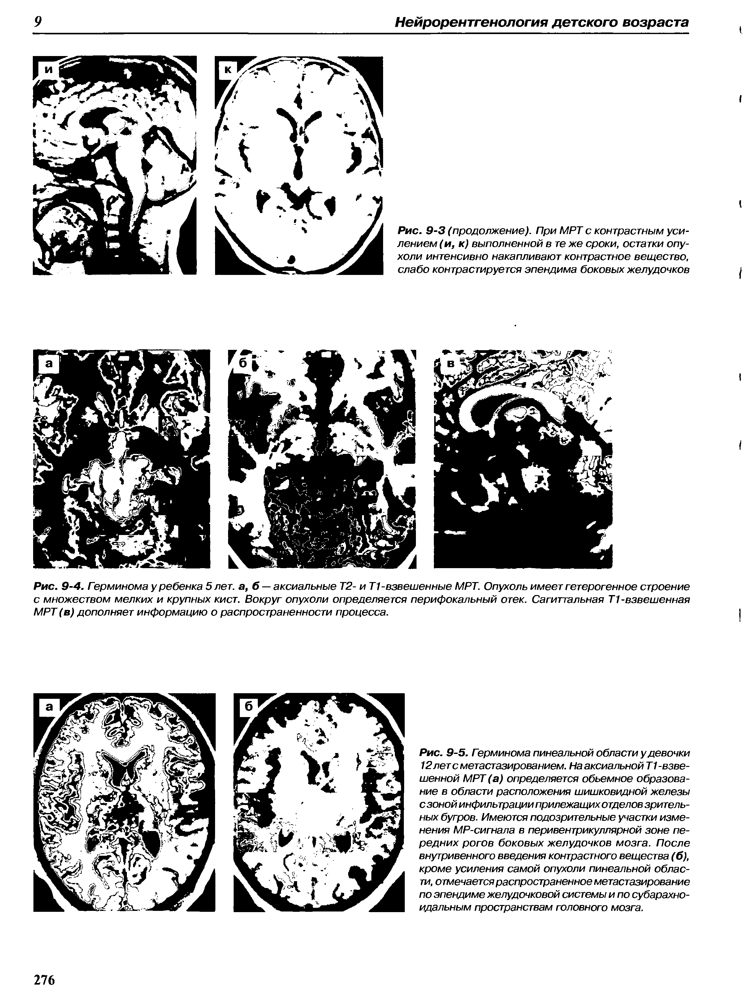 Рис. 9-4. Герминома у ребенка 5 лет. а, б — аксиальные Т2- и Т1 -взвешенные МРТ. Опухоль имеет гетерогенное строение с множеством мелких и крупных кист. Вокруг опухоли определяется перифокальный отек. Сагиттальная Т1 -взвешенная МРТ (в) дополняет информацию о распространенности процесса.