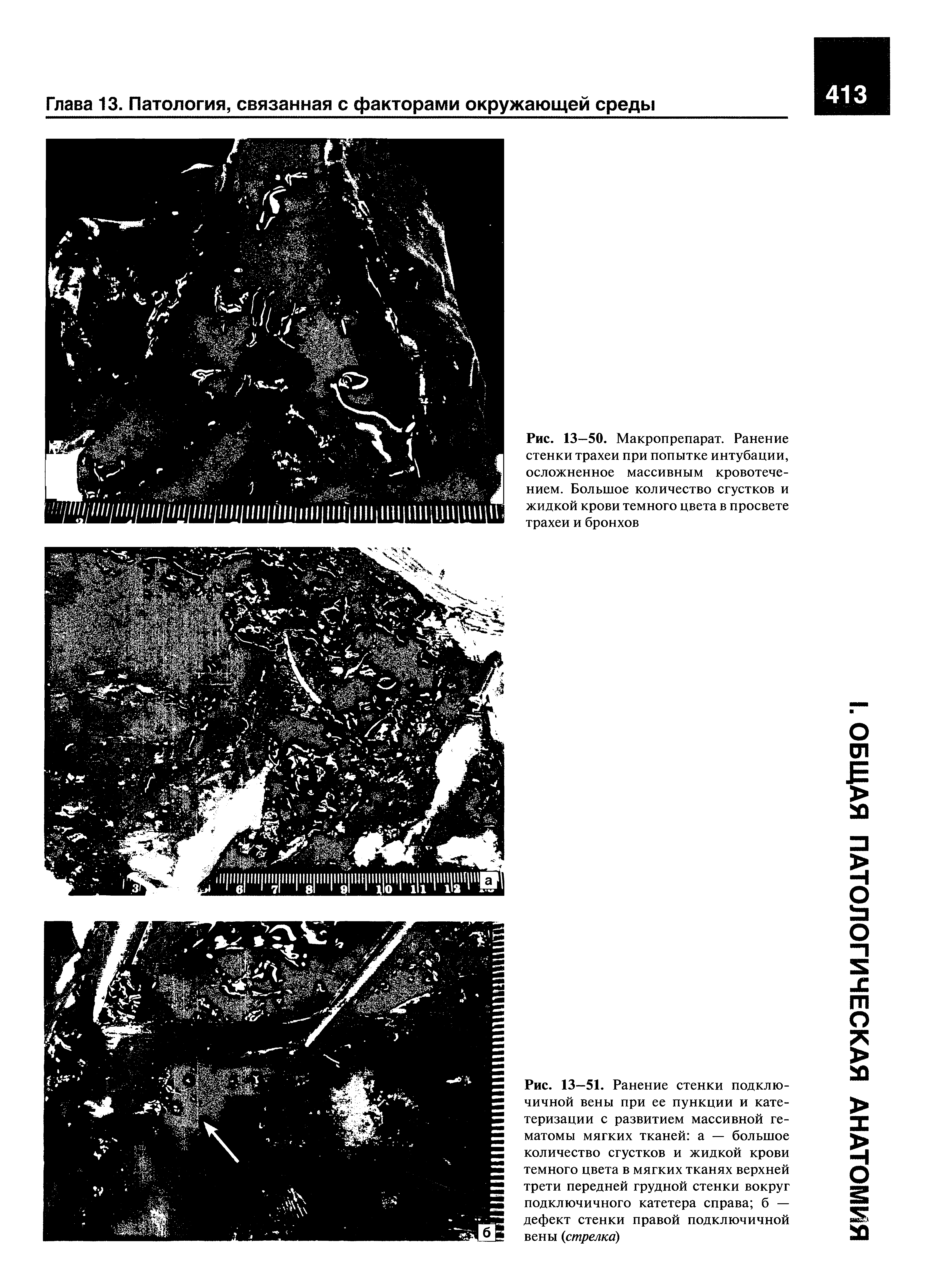 Рис. 13—50. Макропрепарат. Ранение стенки трахеи при попытке интубации, осложненное массивным кровотечением. Большое количество сгустков и жидкой крови темного цвета в просвете трахеи и бронхов...