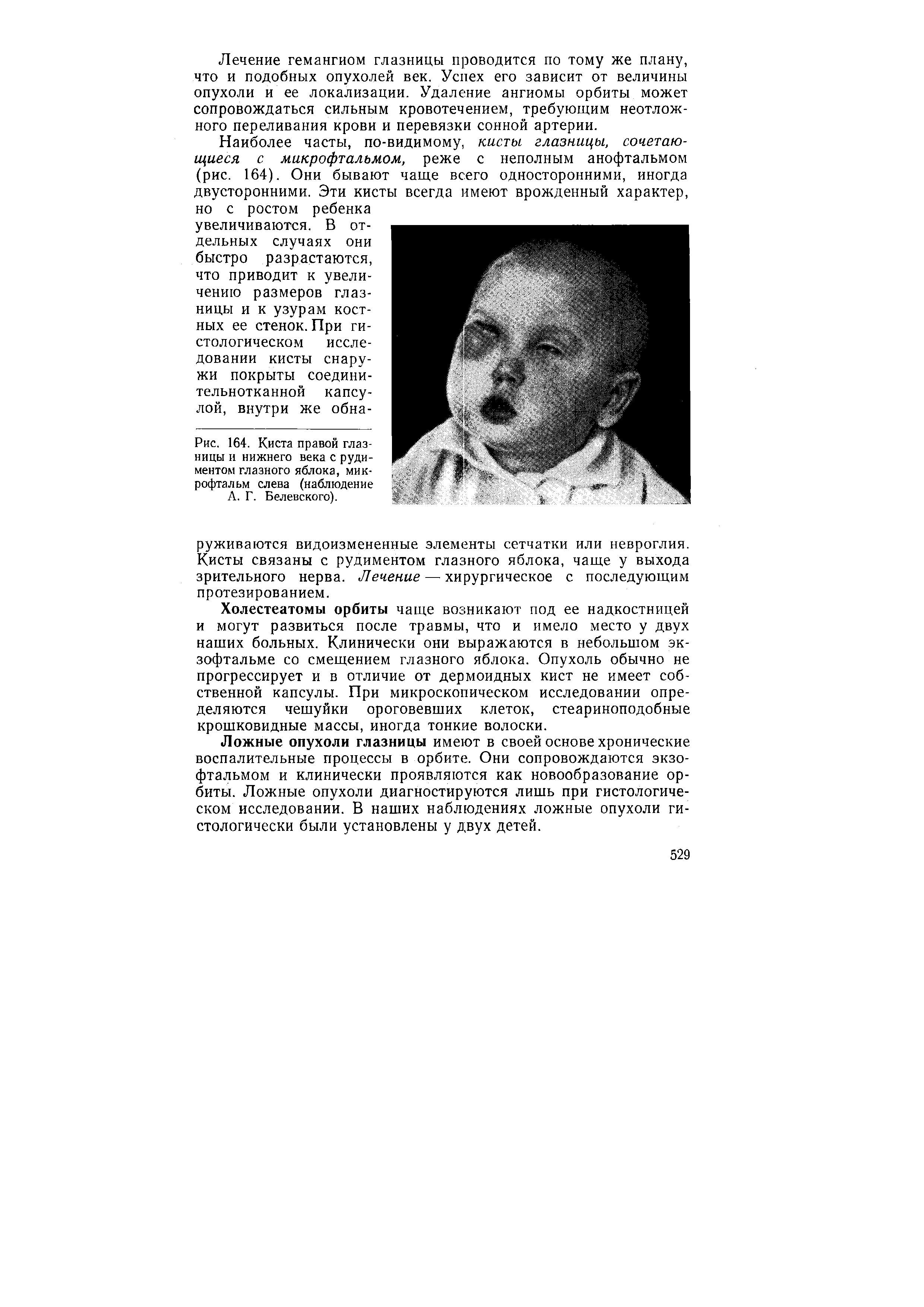 Рис. 164. Киста правой глазницы и нижнего века с рудиментом глазного яблока, микрофтальм слева (наблюдение А. Г. Белевского).