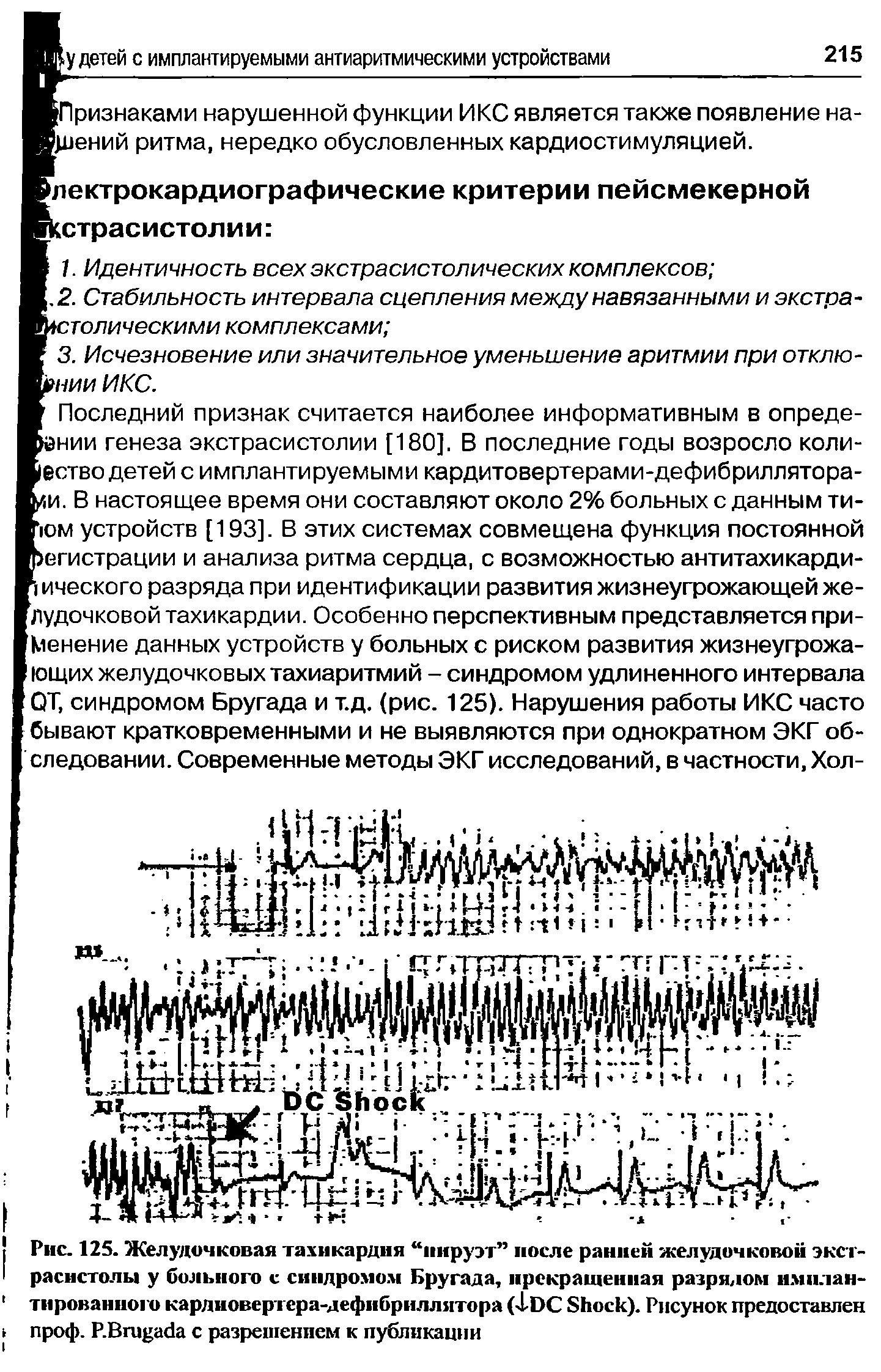 Рис. 125. Желудочковая тахикардия пируэт после ранней желудочковой экстрасистолы у больного с синдромом Бругада, прекращенная разрядом имплантированного кардиовертера-дефибриллятора (J-DC S ). Рисунок предоставлен проф. P.B с разрешением к публикации...