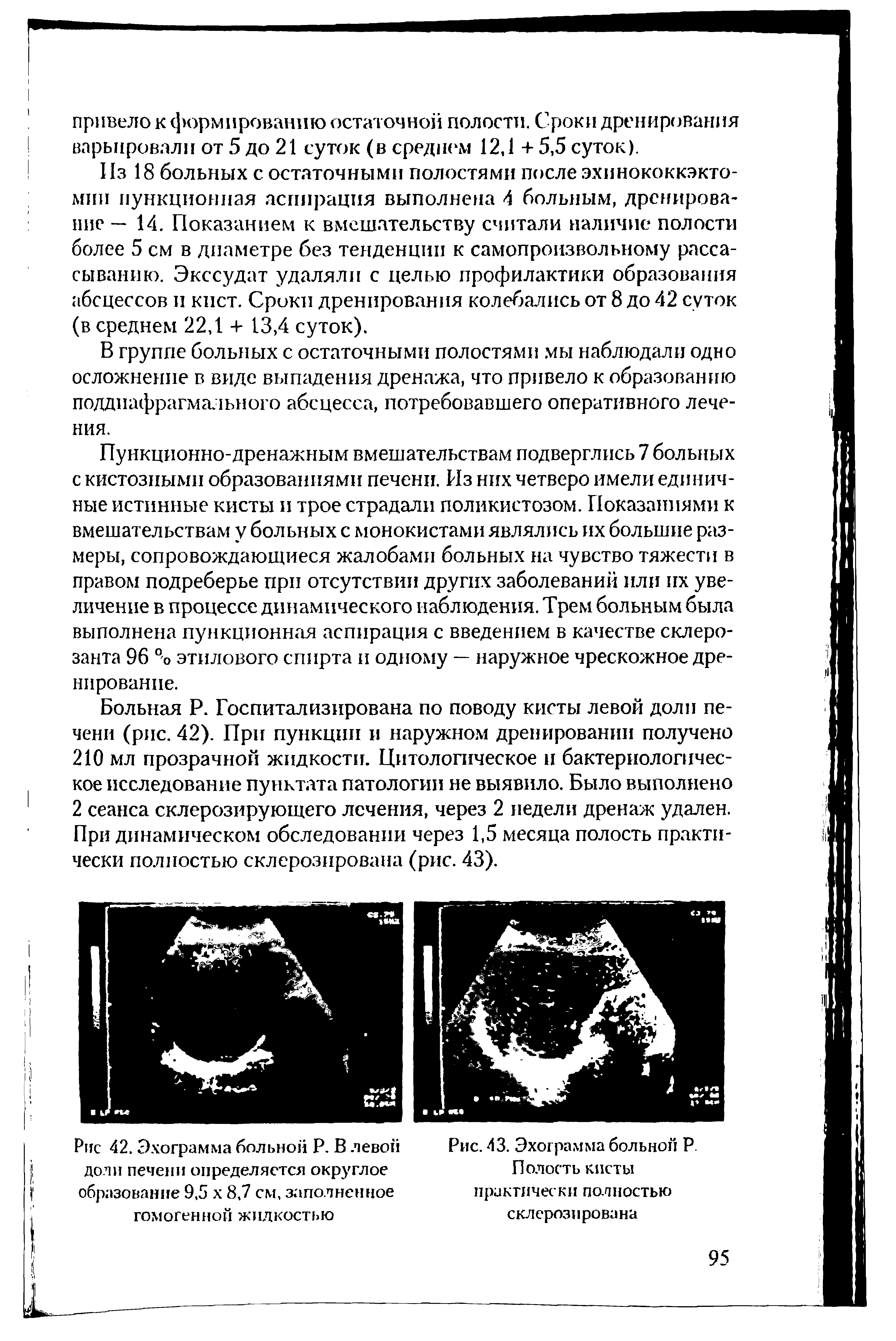 Рис. 43. Эхограмма больной Р Полость кисты практически полностью склерозирована...