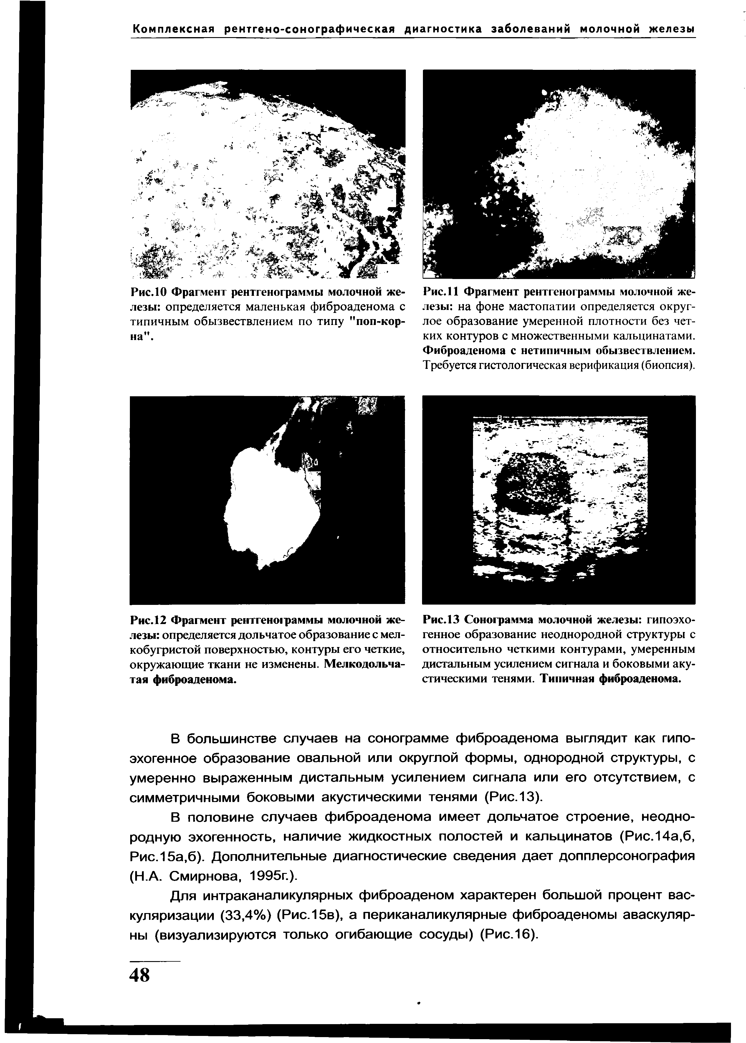 Рис.И Фрагмент рентгенограммы молочной железы на фоне мастопатии определяется округлое образование умеренной плотности без четких контуров с множественными кальцинатами. Фиброаденома с нетипичным обызвествлением. Требуется гистологическая верификация (биопсия).