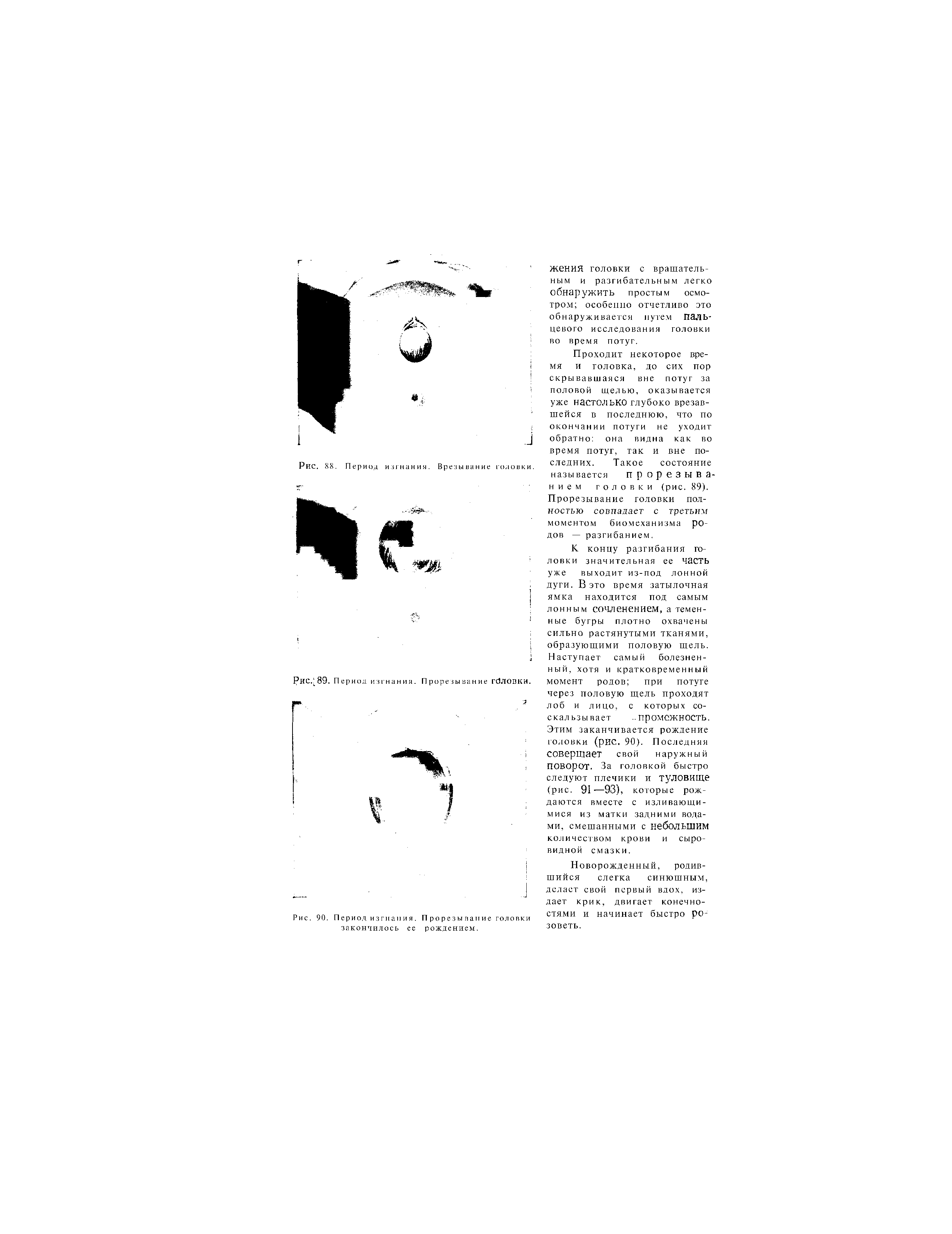 Рис. 90. Период изгнания. Прорезывание головки закончилось ее рождением.