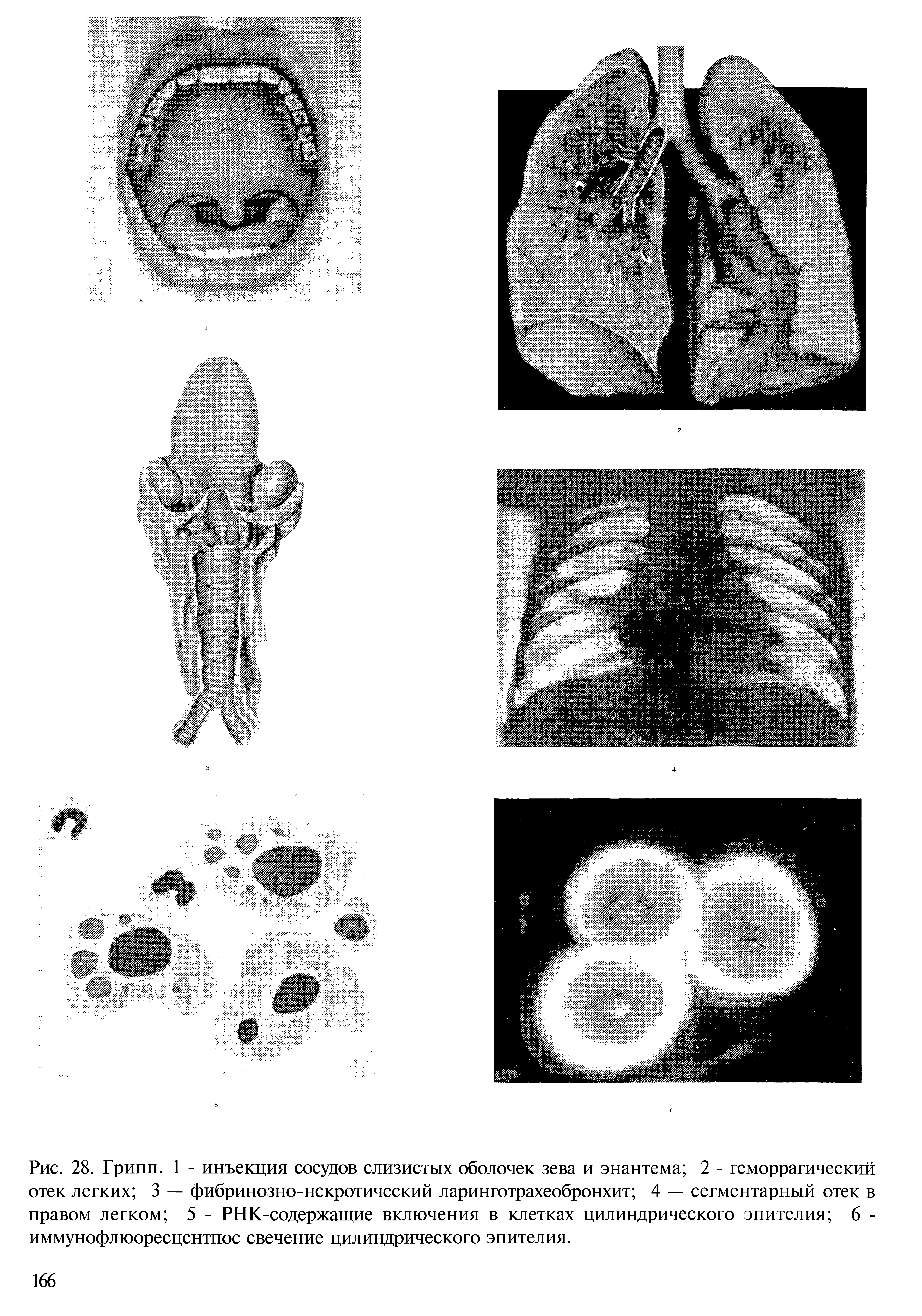 Рис. 28. Грипп. 1 - инъекция сосудов слизистых оболочек зева и энантема 2 - геморрагический отек легких 3 — фибринозно-некротический ларинготрахеобронхит 4 — сегментарный отек в правом легком 5 - РНК-содержащие включения в клетках цилиндрического эпителия 6 -иммунофлюоресцснтпос свечение цилиндрического эпителия.