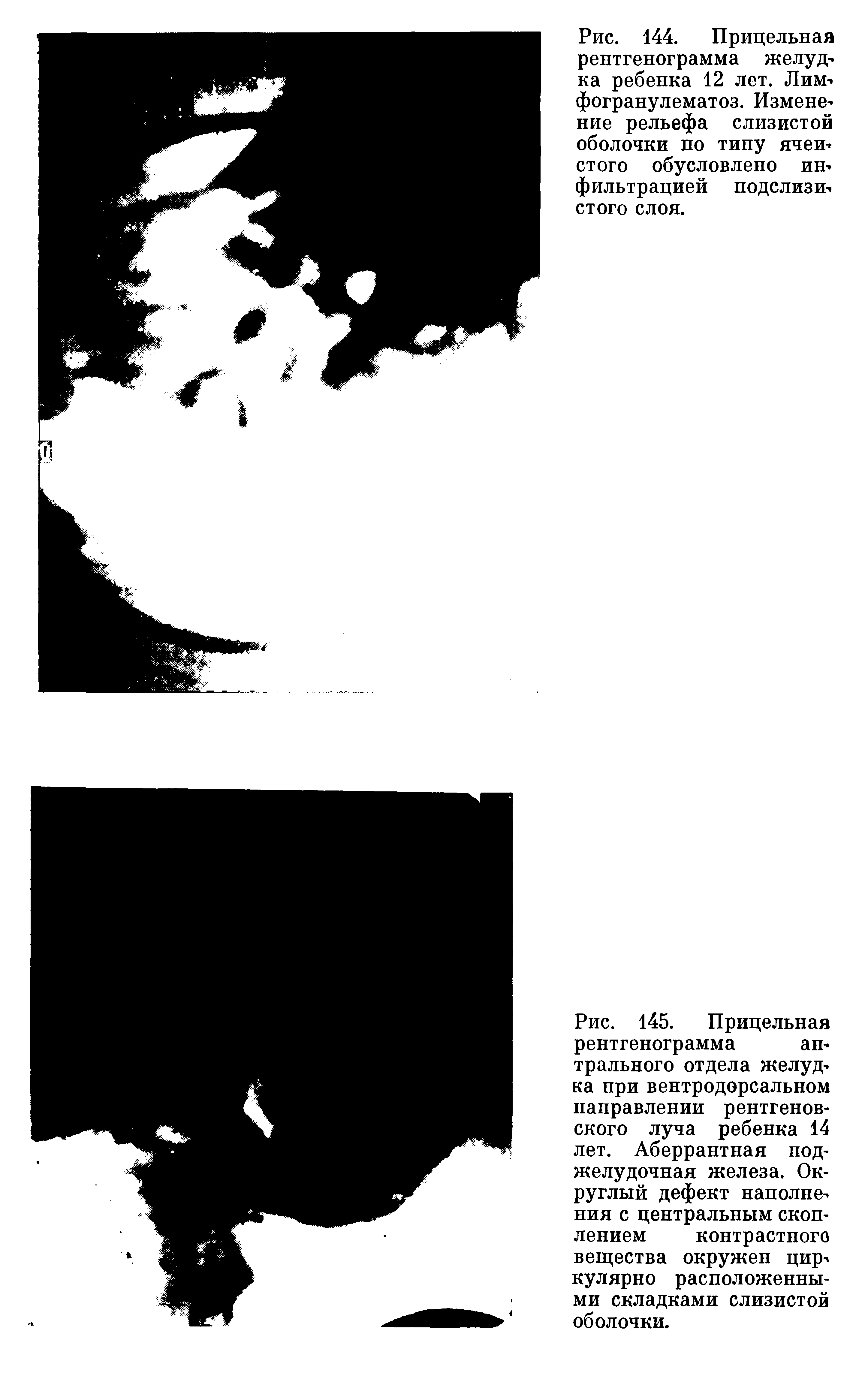 Рис. 145. Прицельная рентгенограмма антрального отдела желудка при вентродорсальном направлении рентгеновского луча ребенка 14 лет. Аберрантная поджелудочная железа. Округлый дефект наполнения с центральным скоплением контрастного вещества окружен циркулярно расположенными складками слизистой оболочки.