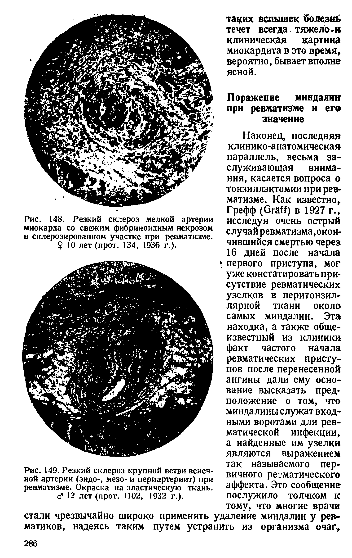 Рис. 149. Резкий склероз крупной ветви венечной артерии (эндо-, мезо- и периартериит) при ревматизме. Окраска на эластическую ткань. сГ 12 лет (прот. 1102, 1932 г.).