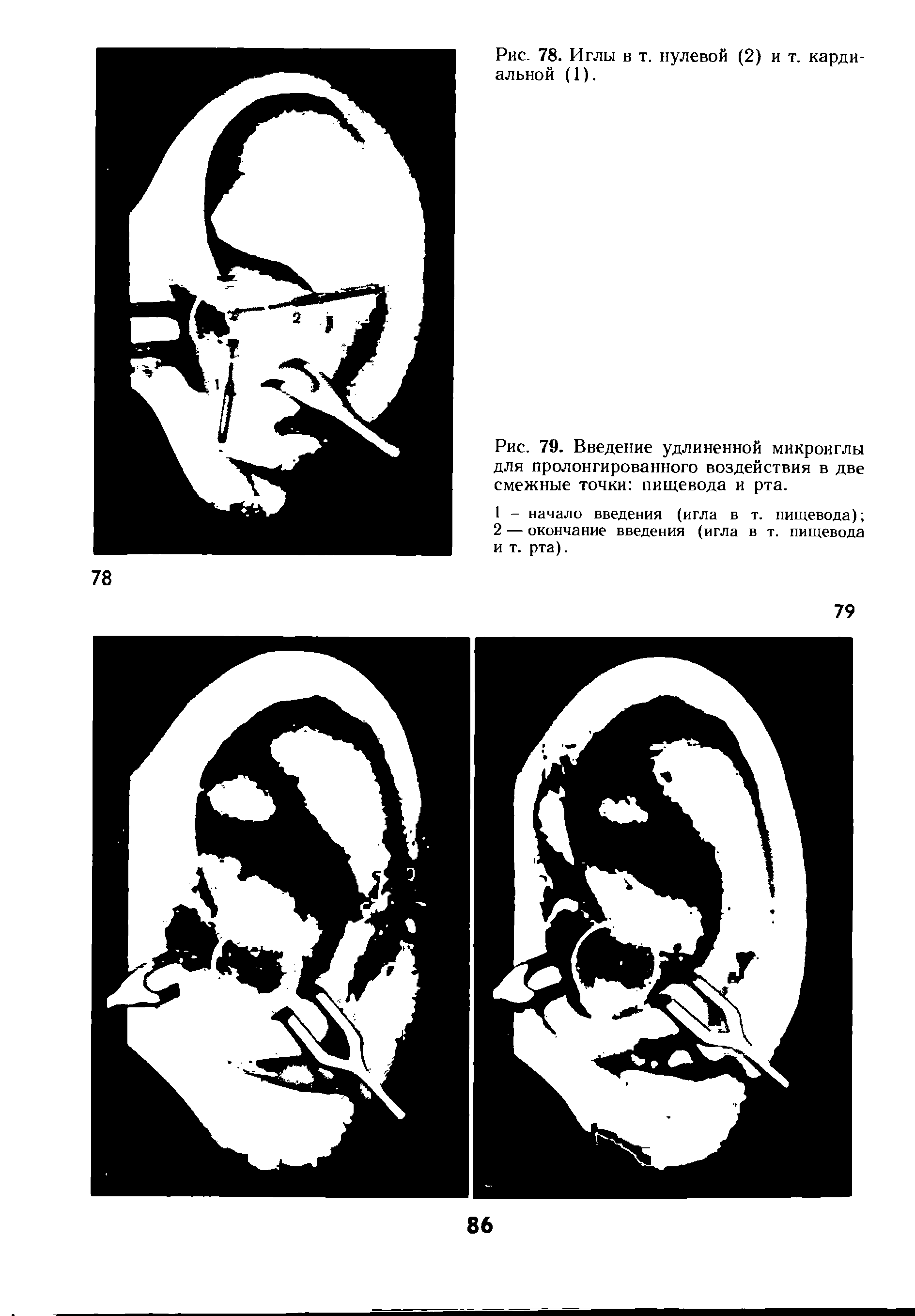 Рис. 79. Введение удлиненной микроиглы для пролонгированного воздействия в две смежные точки пищевода и рта.