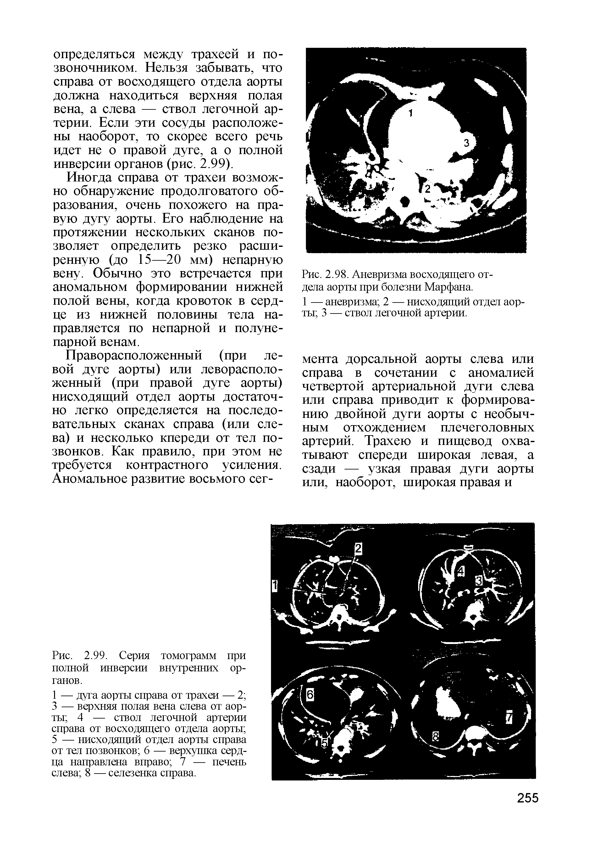 Рис. 2.99. Серия томограмм при полной инверсии внутренних органов.