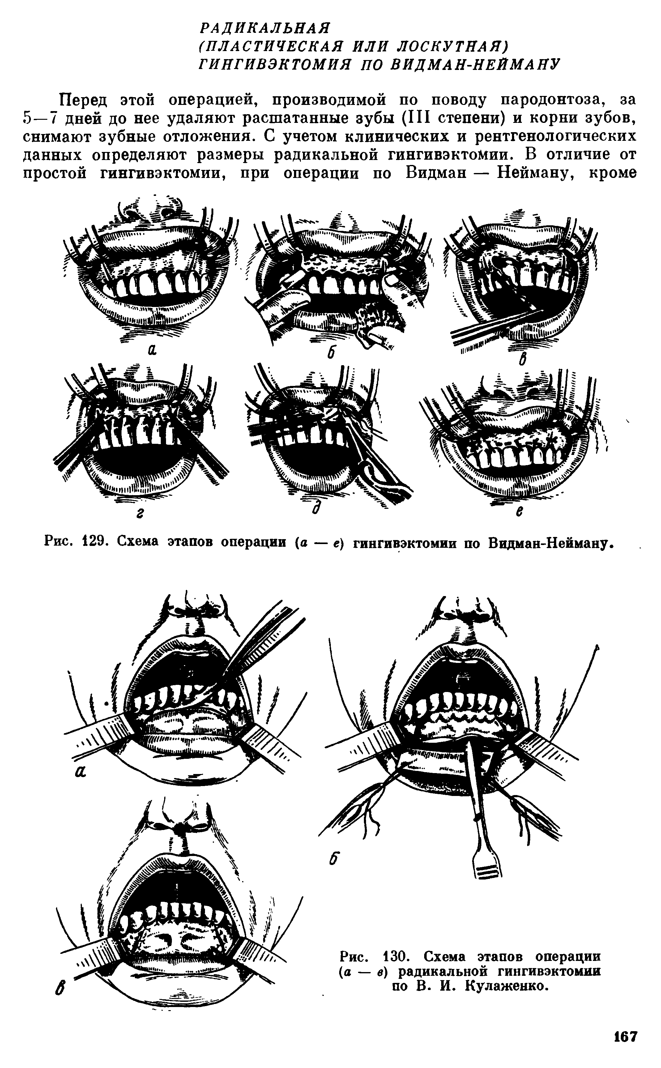 Рис. 130. Схема этапов операции (а — в) радикальной гингивэктомии по В. И. Кулаженко.