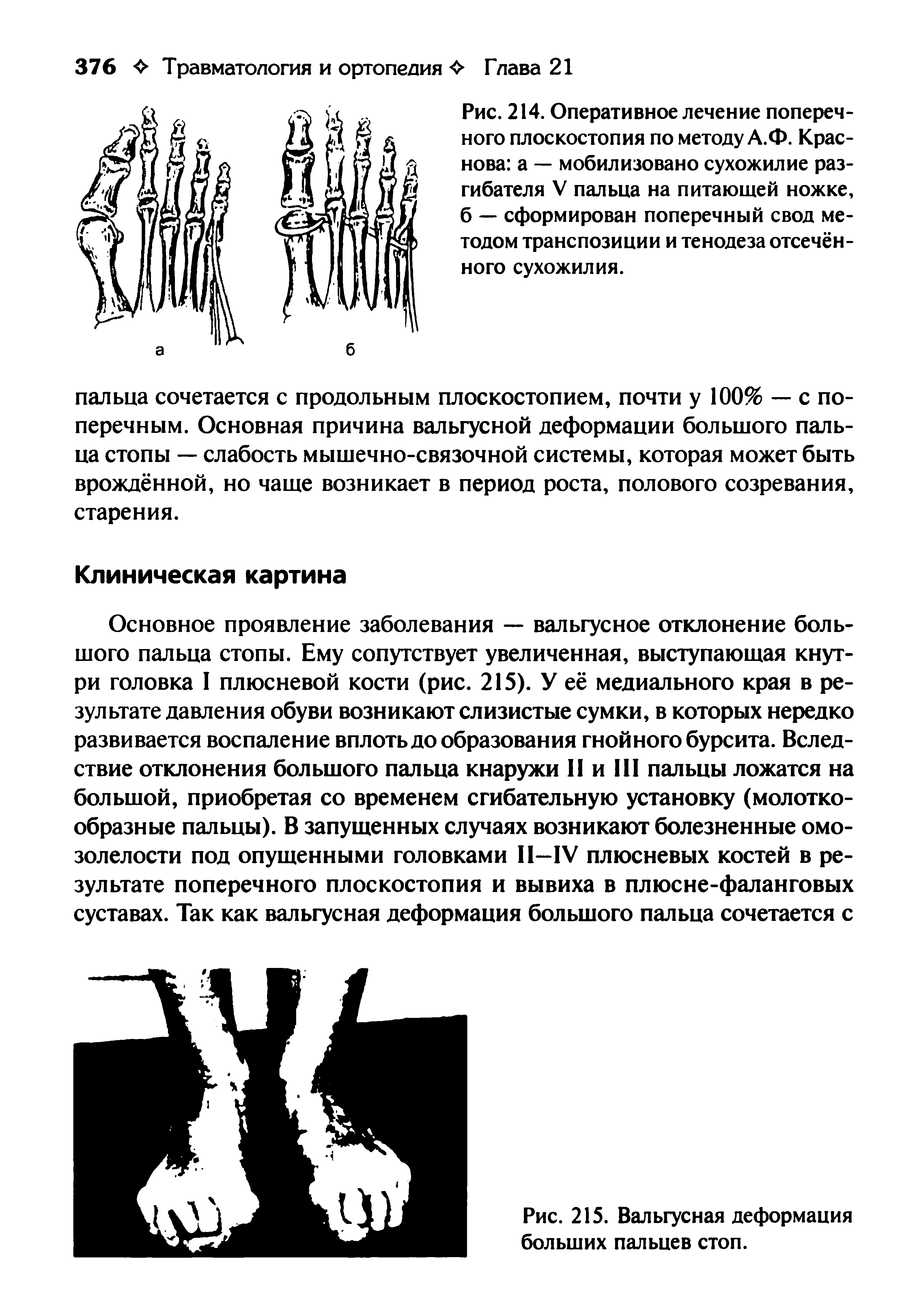 Рис. 214. Оперативное лечение поперечного плоскостопия по методу А.Ф. Краснова а — мобилизовано сухожилие разгибателя V пальца на питающей ножке, б — сформирован поперечный свод методом транспозиции и тенодеза отсечённого сухожилия.